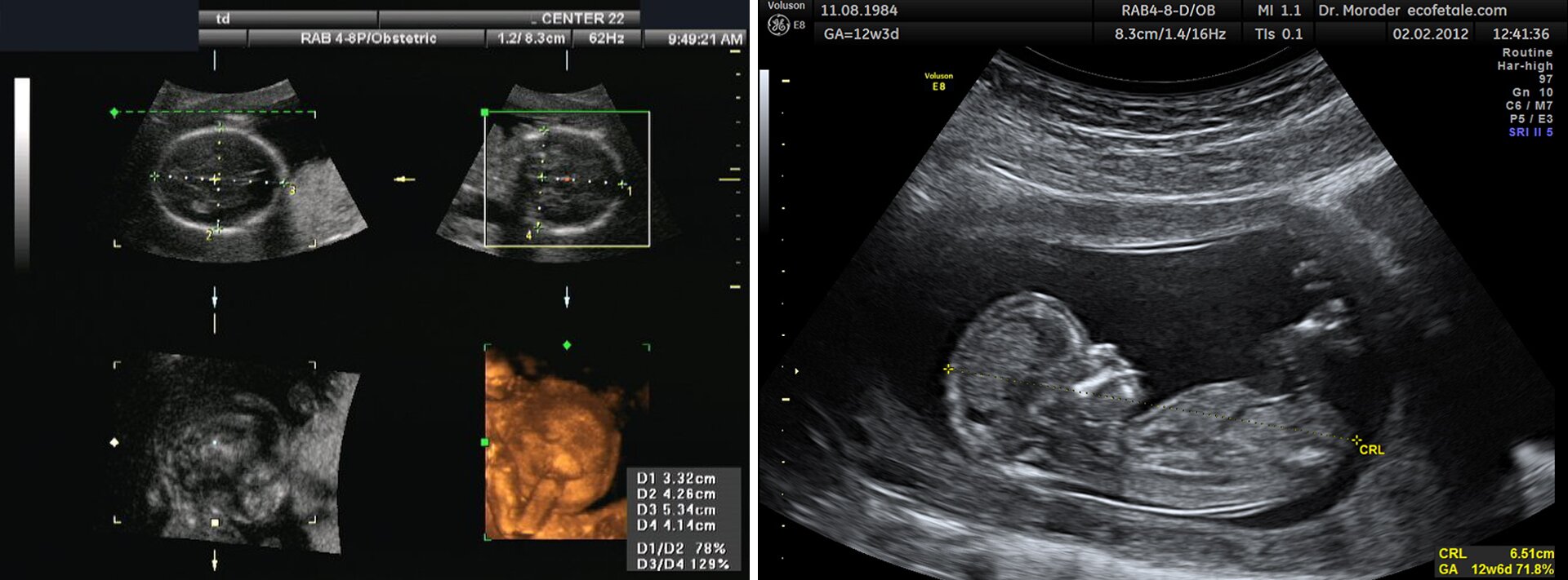 Ilustracja przedstawia dwa zdjęcia obrazów USG. Są one biało‑czarne i rozmazane, jednak zarys dziecka w macicy jest widoczny.