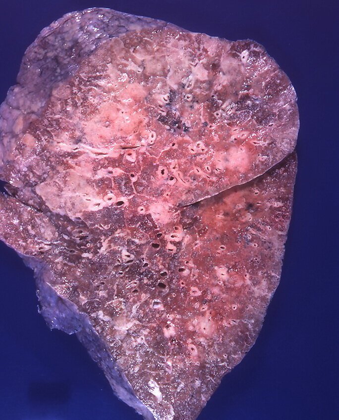 Zdjęcie przedstawia fragment płuca. Ma ono nienaturalny brązowy kolor. Tkanki płuca są zmienione, włókniste.