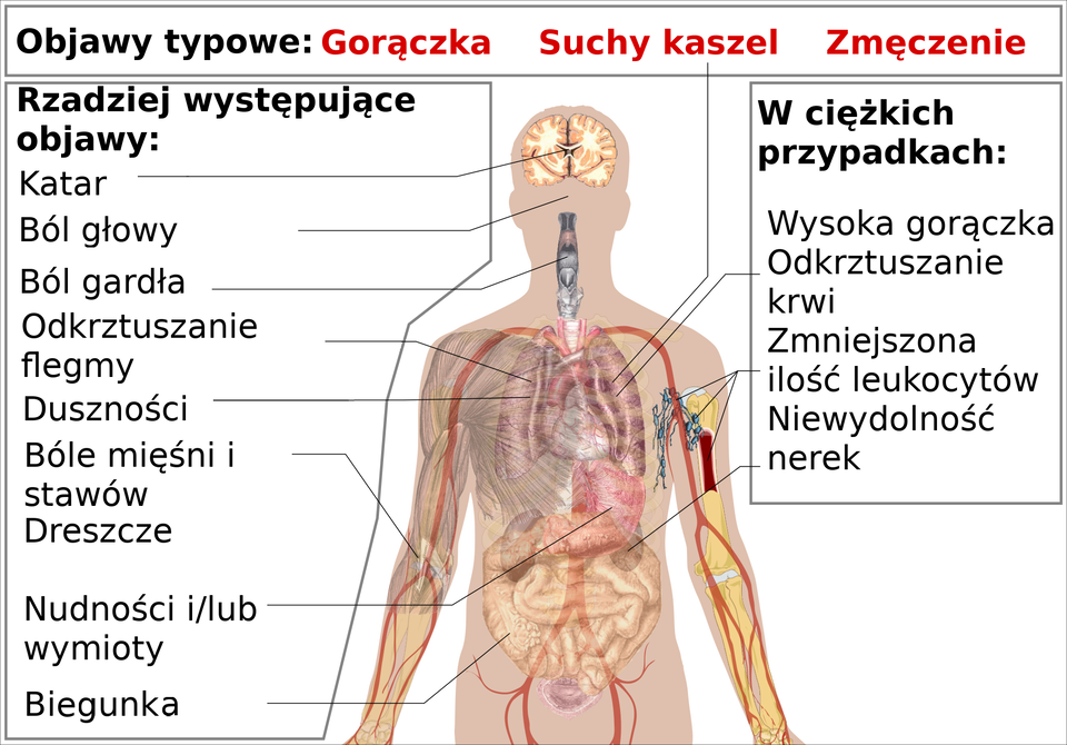 Grafika przedstawia model anatomiczny człowieka. Na ilustrację naniesiono wybrane objawy COVID-19. Objawy typowe opisano u góry rysunku. Są to gorączka, suchy kaszel oraz zmęczenie.  Po lewej stronie modelu opisano rzadziej występujące objawy: katar, ból głowy, gardła, odkrztuszanie flegmy, duszności, bóle mięśni i stawów, dreszcze, nudności i wymioty oraz biegunka.  Po stronie prawej wymieniono objawy występujące w ciężkich przypadkach: wysoką gorączkę, odkrztuszanie krwi, zmniejszoną ilość leukocytów oraz niewydolność nerek. 
