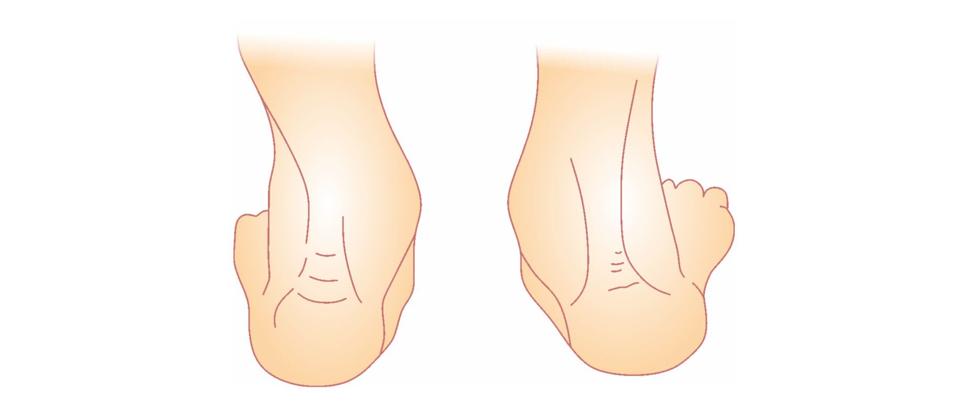 Grafika przedstawia tył stóp, których pięty są odchylone do zewnętrznej strony, a kostki – do strony wewnętrznej.