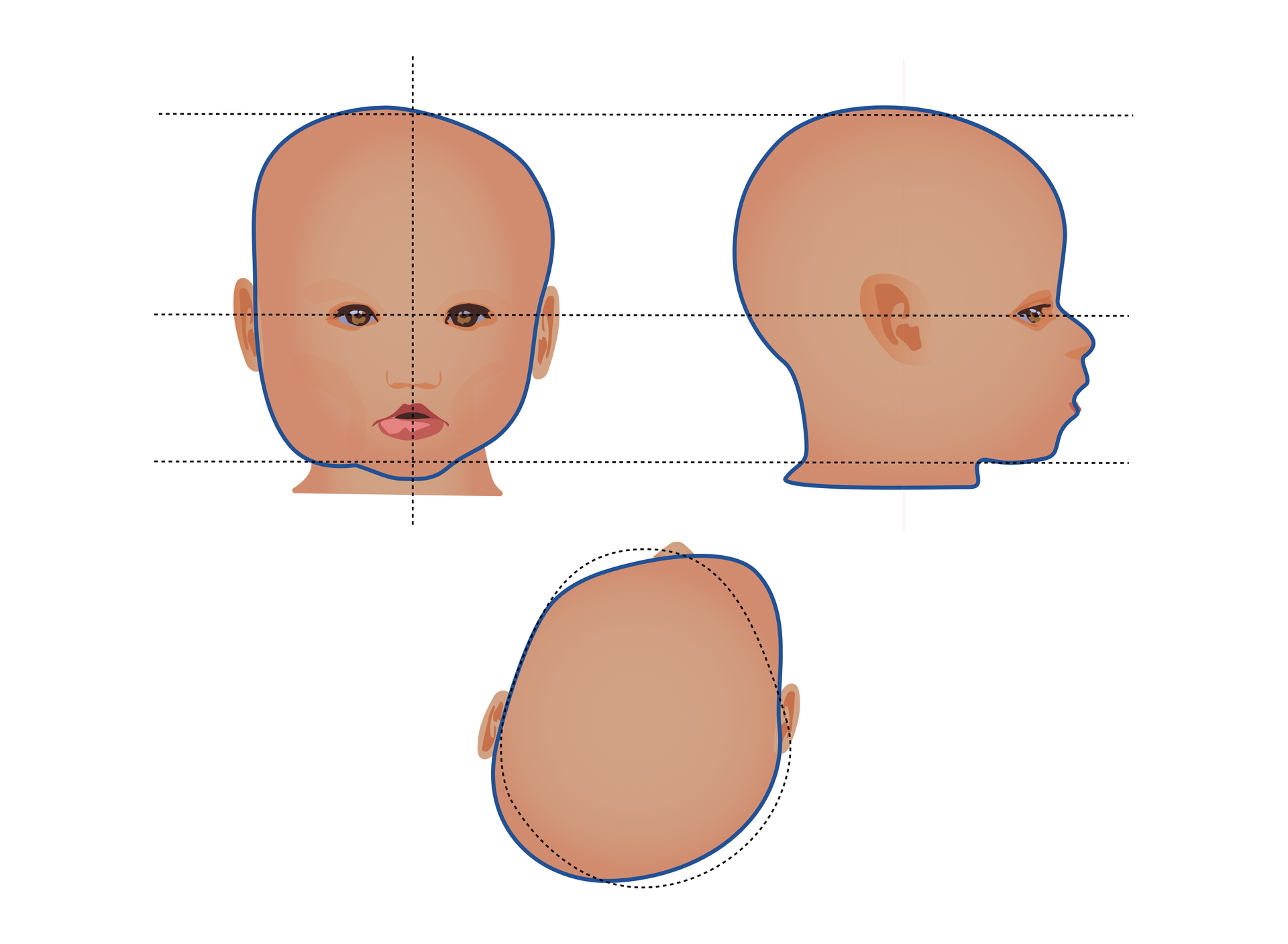 Schemat głowy dziecka z plagiocefalią przedstawiony z przodu, góry i boku. Głowa jest wyraźnie wykrzywiona, co najlepiej uwidacznia rzut z góry i z przodu.
