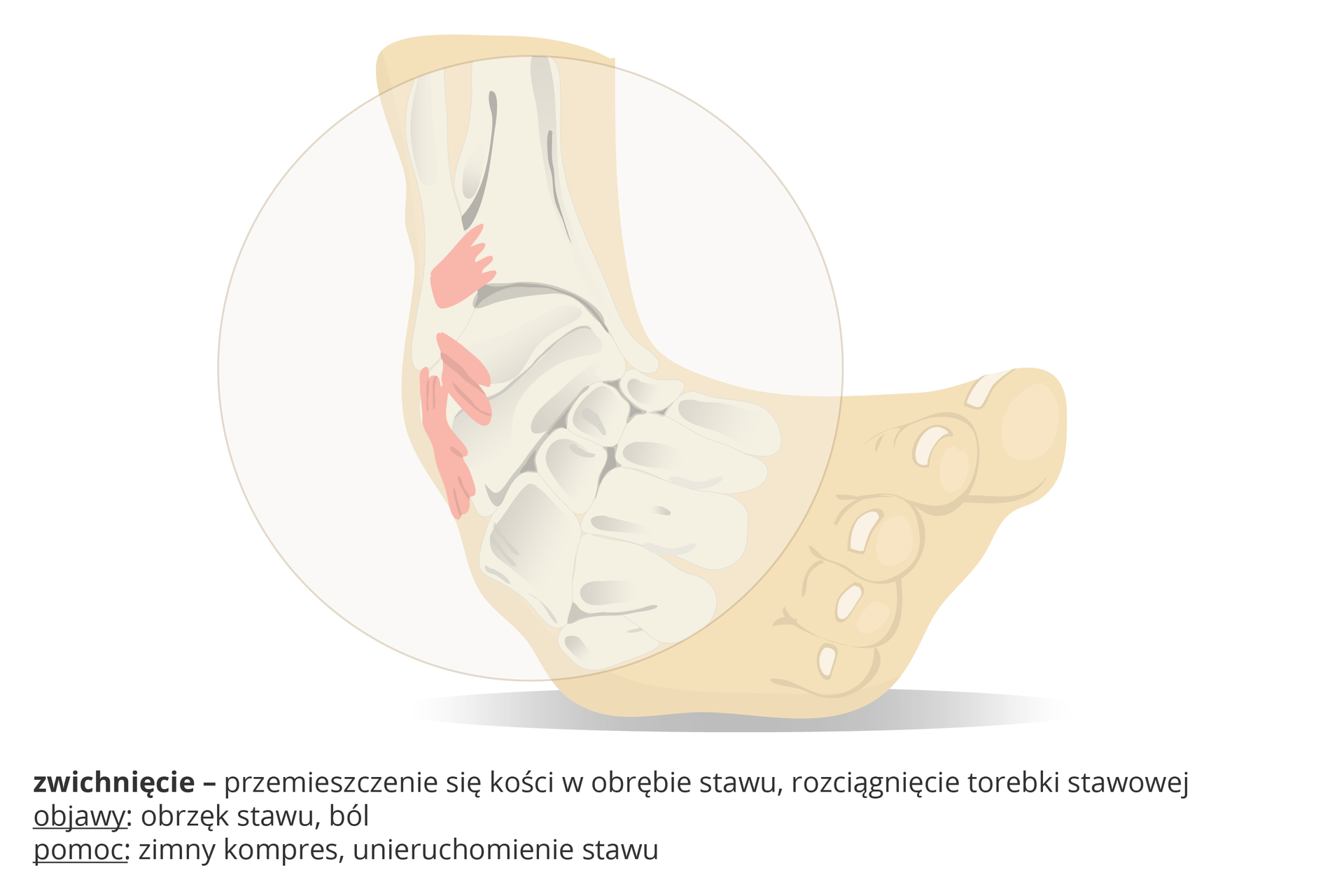 Ilustracja przedstawia schematycznie nienaturalnie wygiętą stopę, kółkiem zaznaczono obszar zwichnięcia, czyli przemieszczenia kości w stawie i naciągnięcia torebki stawowej. Objawy: obrzęk stawu, ból. Pomoc: zimny kompres, unieruchomienie stawu.
