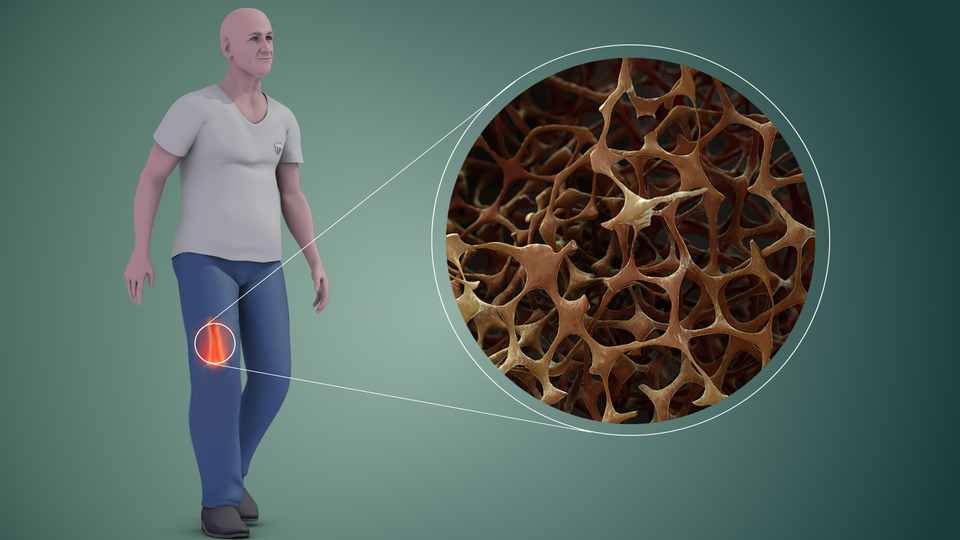 Na ilustracji przedstawiono postać ludzką z zaznaczonym okręgiem kawałkiem kości udowej. Z okręgu tego wyprowadzono dwie linie, na końcu których zamieszczono w większym okręgu obrazek przedstawiający wnętrze kości. Jest to brązowa siatka o dużych, nieregularnych otworach. Wskazuje to na ubytek masy kostnej, czyli osteoporozę. 