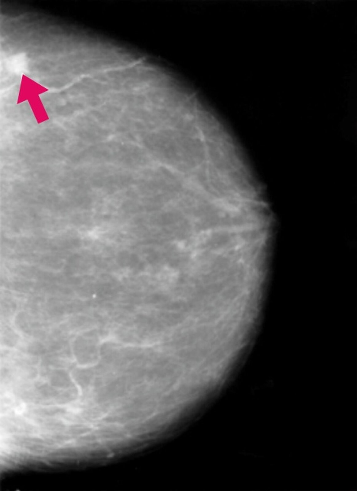 Na czarnym tle widoczny jest szary półokrąg przez który przebiegają białe linie. Na górze półokręgu znajduje się biała, niewielka plama, na którą wskazuje czerwona strzałka.