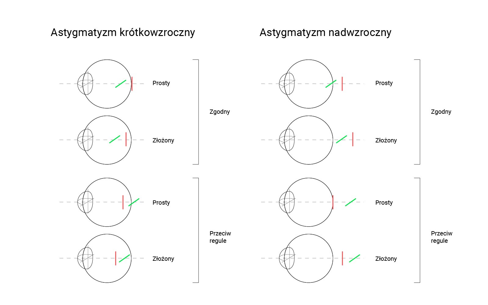 Grafika przedstawia położenie ognisk przekrojów głównych w wybranych typach astygmatyzmu.