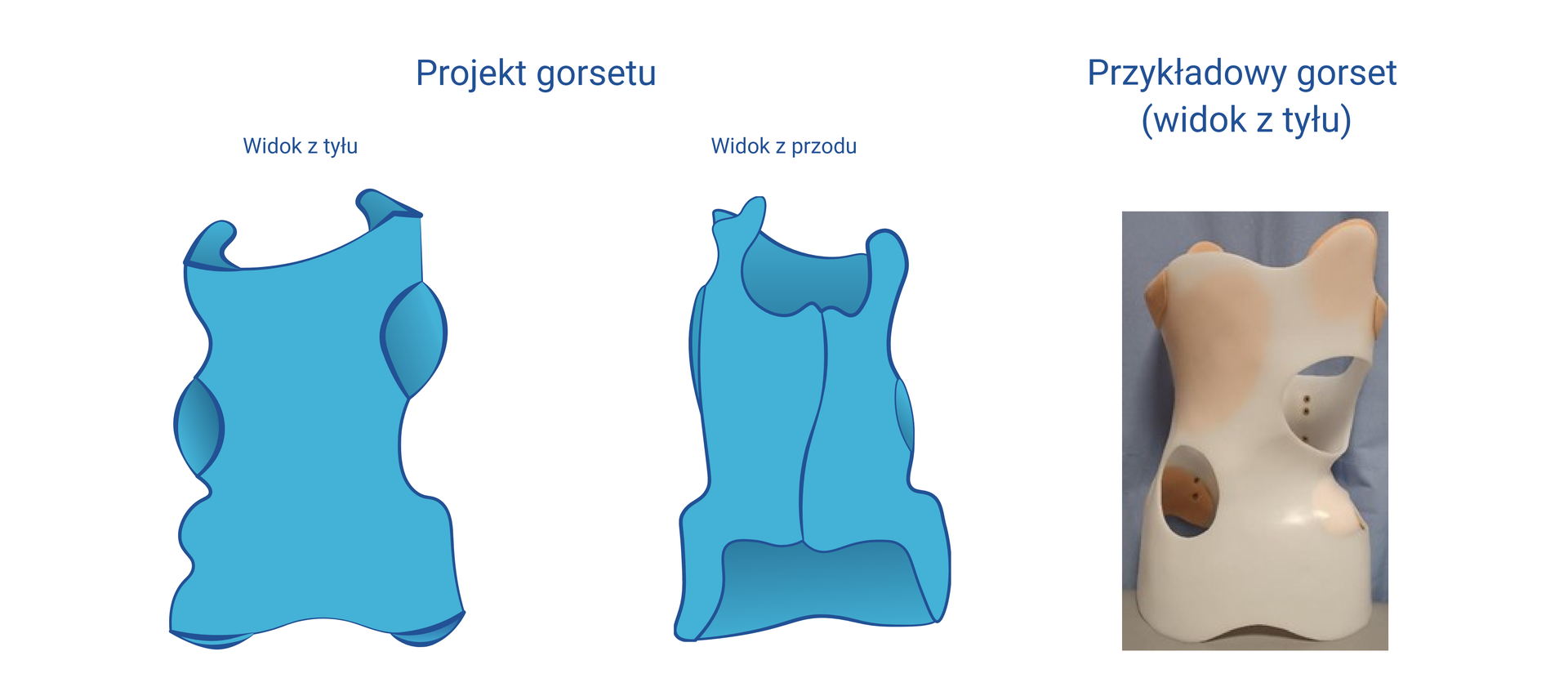 Grafika przedstawiająca schemat gorsetu z przodu i z tyłu. Gorset obejmuje większość tułowia. Na rycinie zamieszczono również zdjęcie przykładowego gorsetu z tworzywa sztucznego w widoku z tyłu.
