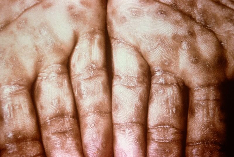 Fotografia przedstawia zmiany skórne na wewnętrznej stronie dłoni spowodowane krętkiem kiły. Na skórze występują niewielkie, gęste bąble. 