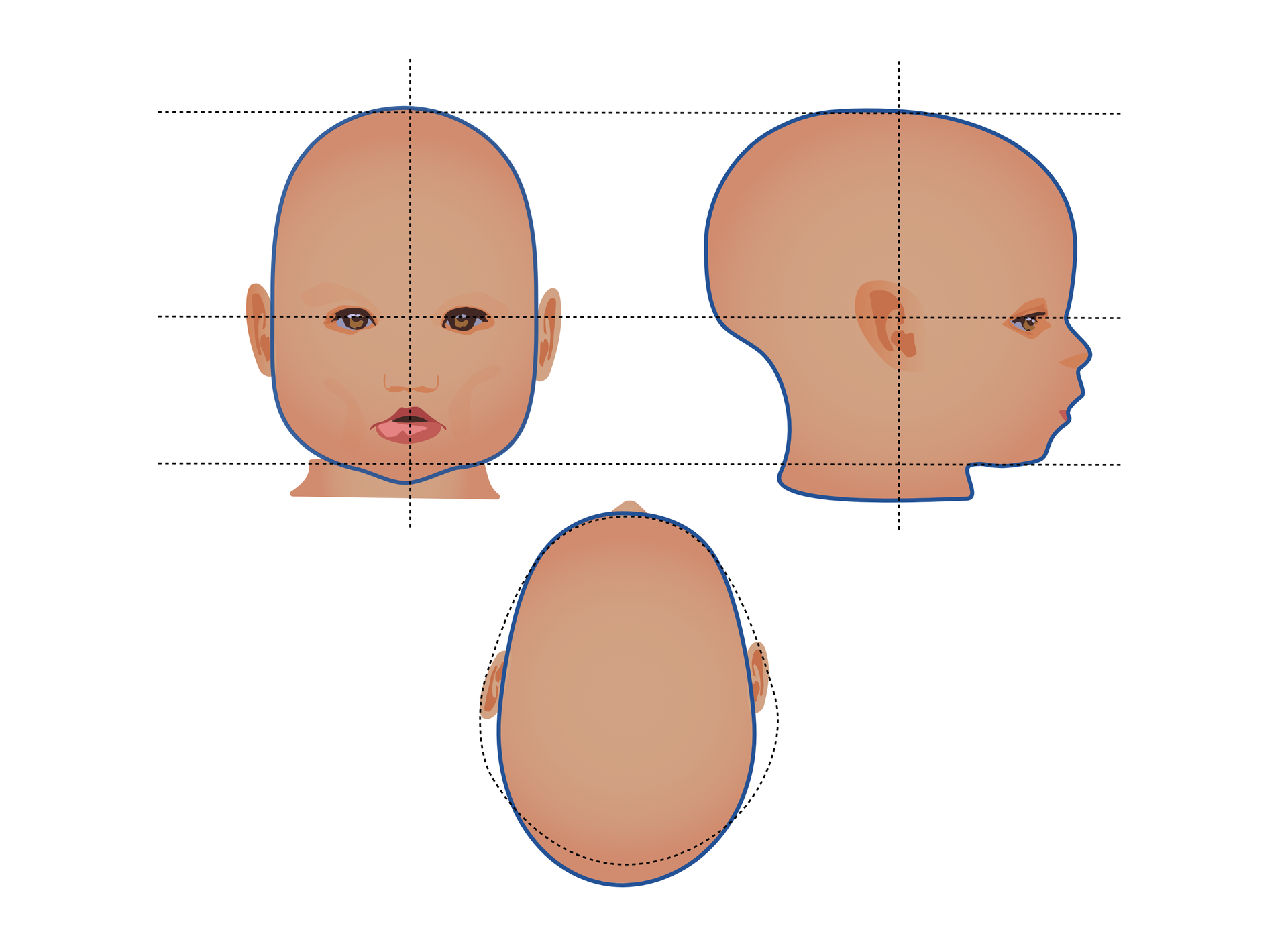 Schemat głowy dziecka z skafocefalią przedstawiony z przodu, góry i boku. Głowa jest spłaszczona z boków i wydłużona ku tyłowi.
