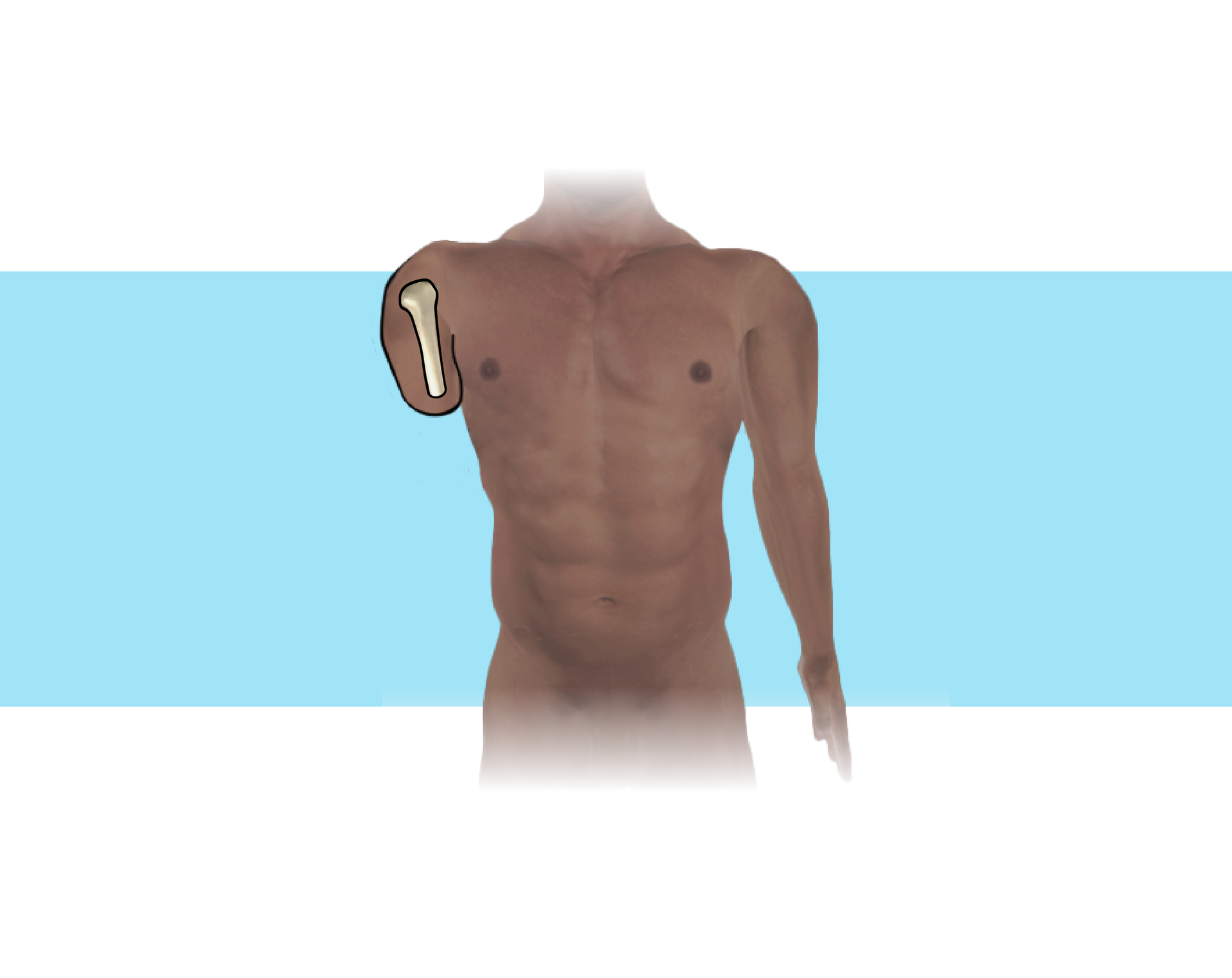 Grafika przedstawia ciało człowieka z bardzo krótkim kikutem ramienia. Na rycinie zaprezentowano kość ramienną po amputacji w jednej trzeciej długości.