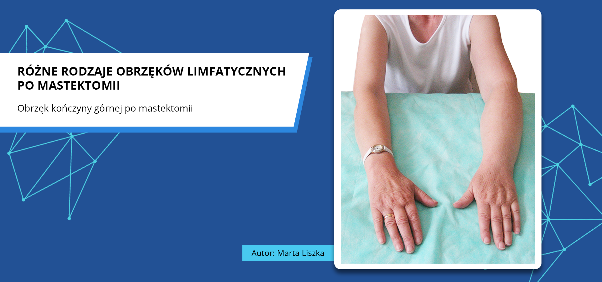 Zdjęcie o tytule różne rodzaje obrzęków limfatycznych po mastektomii. Obrzęk kończyny górnej po mastektomii. Zdjęcie przedstawia wyprostowane kończyny górne pacjentki. Lewa kończyna górna jest opuchnięta w rejonie ramienia i przedramienia. Autorka zdjęcia: Marta Liszka.