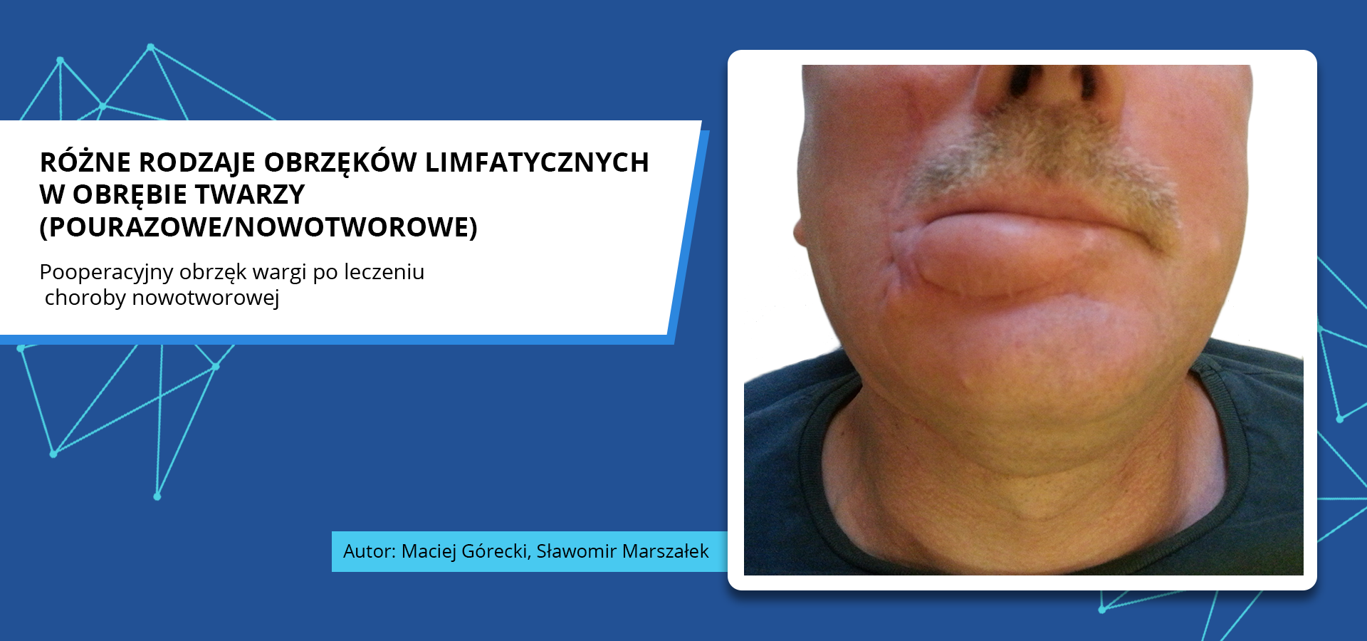 Zdjęcie o tytule różne rodzaje obrzęków limfatycznych w obrębie twarzy, pourazowe lub nowotworowe. Pooperacyjny obrzęk wargi po leczeniu choroby nowotworowej. Zdjęcie przedstawia dolną część twarzy pacjenta. Dolna warga jest opuchnięta, napięta i zaczerwieniona po prawej stronie. Autorzy zdjęcia: Maciej Górecki, Sławomir Marszałek.