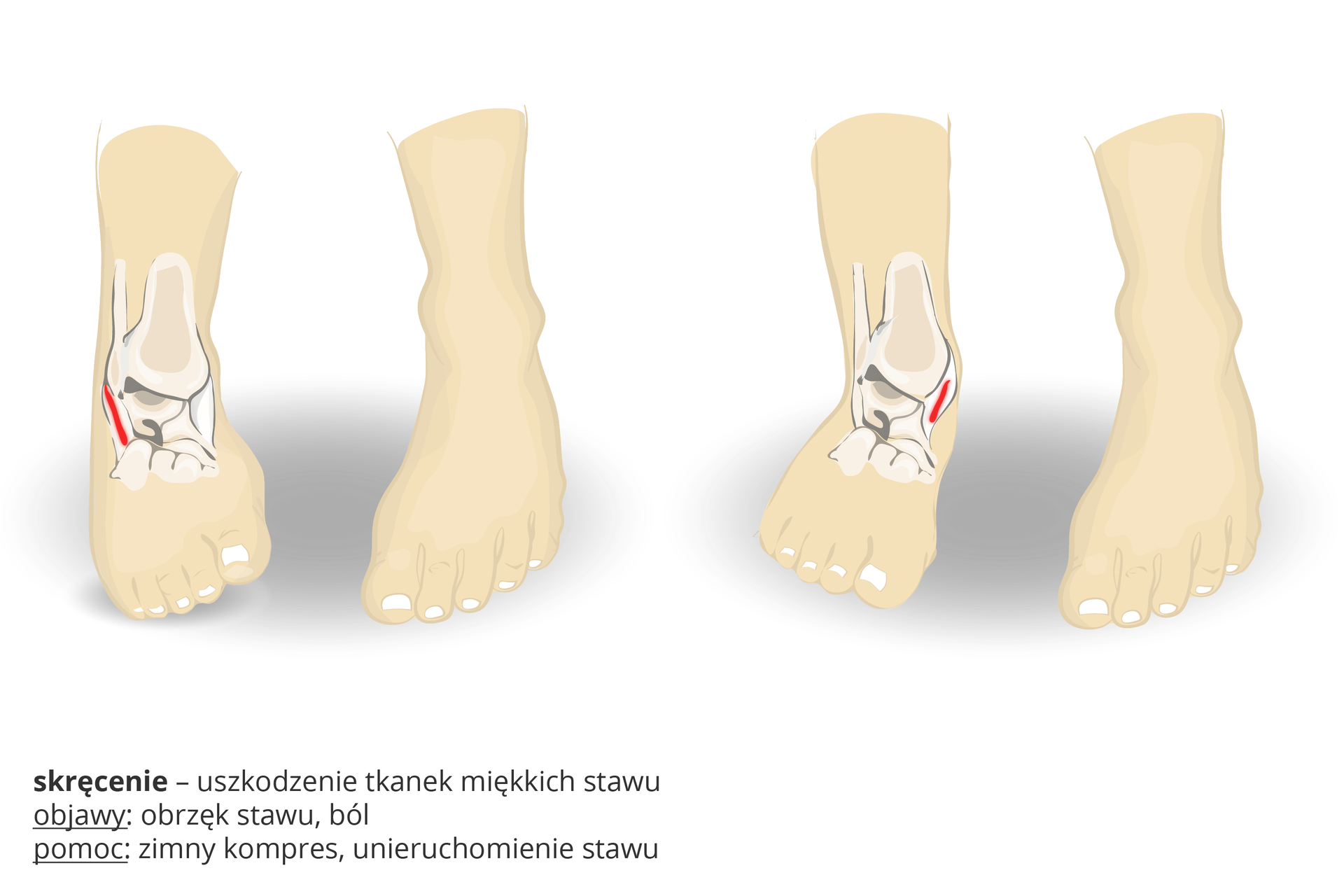 Ilustracja przedstawia dwie pary stóp, z wrysowanymi w jednej kośćmi i stawem skokowym. Czerwone kreski wskazują miejsce urazu: w parze stóp po lewej stronie uraz jest w prawej stopie po stronie zewnętrznej,  natomiast w parze po prawej stronie uraz jest po stronie wewnętrznej prawej kostki. Obrazuje to skręcenia, czyli uszkodzenia tkanek miękkich stawu. Objawy: obrzęk stawu, ból. Pomoc: zimny kompres, unieruchomienie stawu.