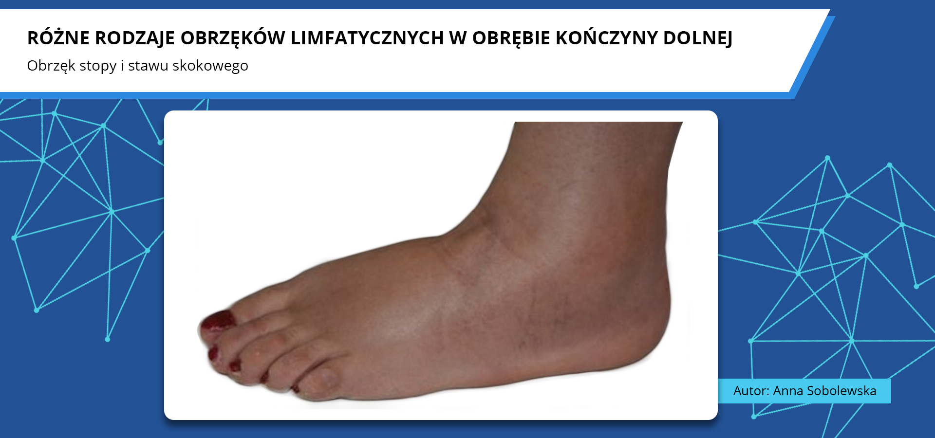 Zdjęcie o tytule różne rodzaje obrzęków limfatycznych w obrębie kończyny dolnej. Obrzęk stopy i stawu skokowego. Zdjęcie przedstawia opuchniętą i zsiniałą stopę człowieka.
Autorka zdjęcia: Anna Sobolewska.