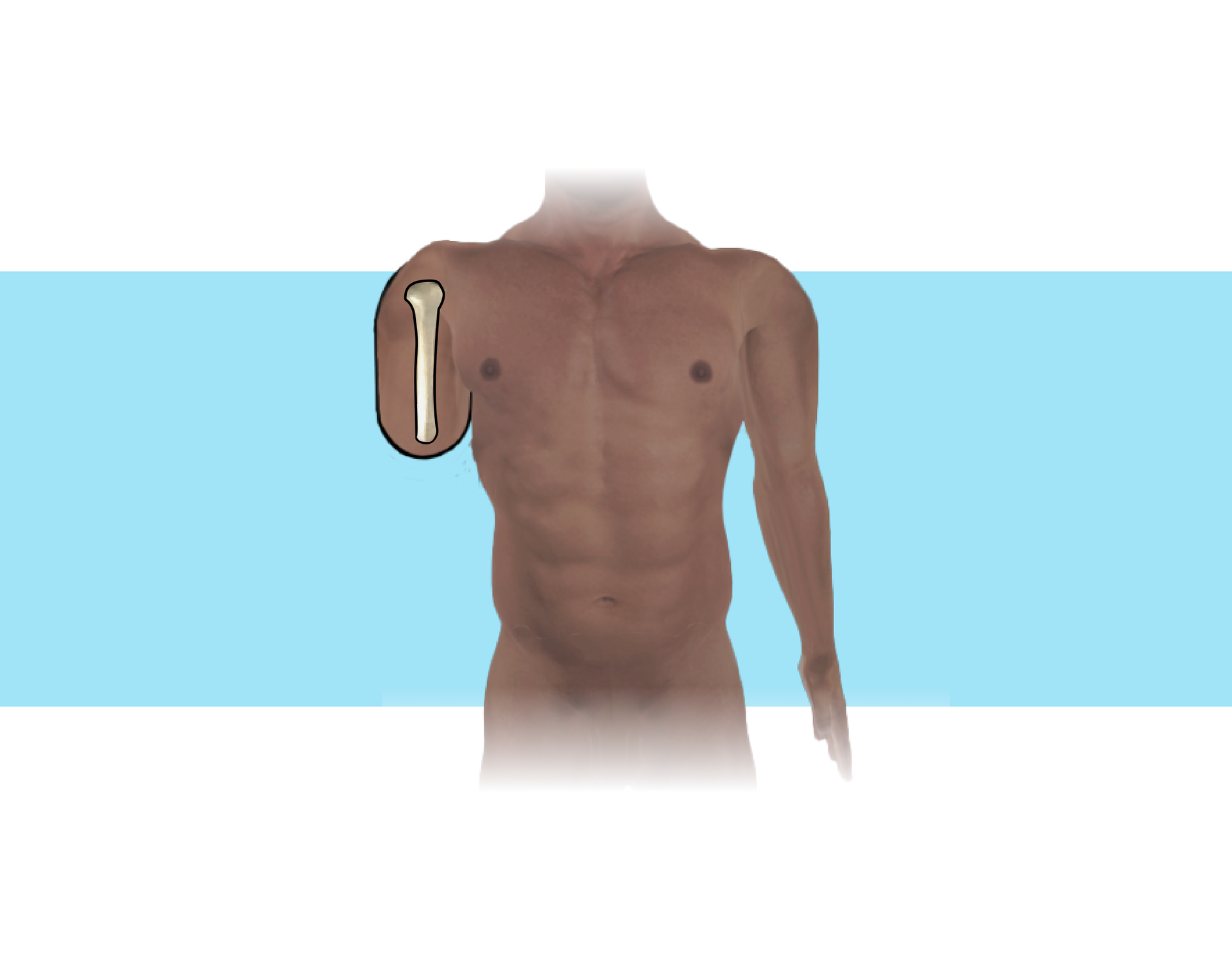 Grafika przedstawia ciało człowieka z krótkim kikutem ramienia. Na rycinie zaprezentowano kość ramienną po amputacji w dwóch trzecich długości.