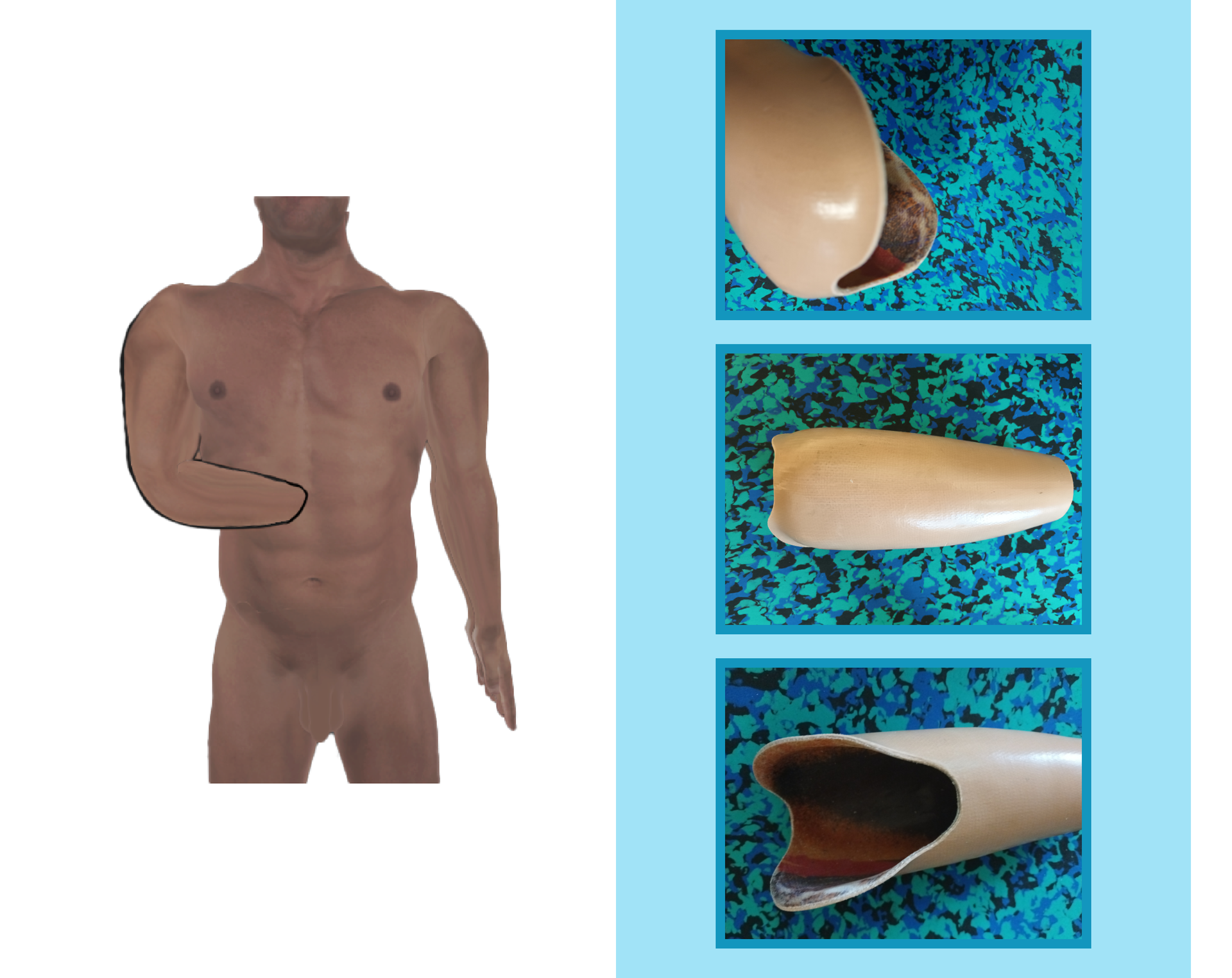 Grafika przedstawia człowieka z długim kikutem przedramienia. Na rycinie zamieszczono również trzy zdjęcia leja w widoku z dołu, góry i boku. Dopasowany do kikuta lej jest wykonany z tworzywa sztucznego.
