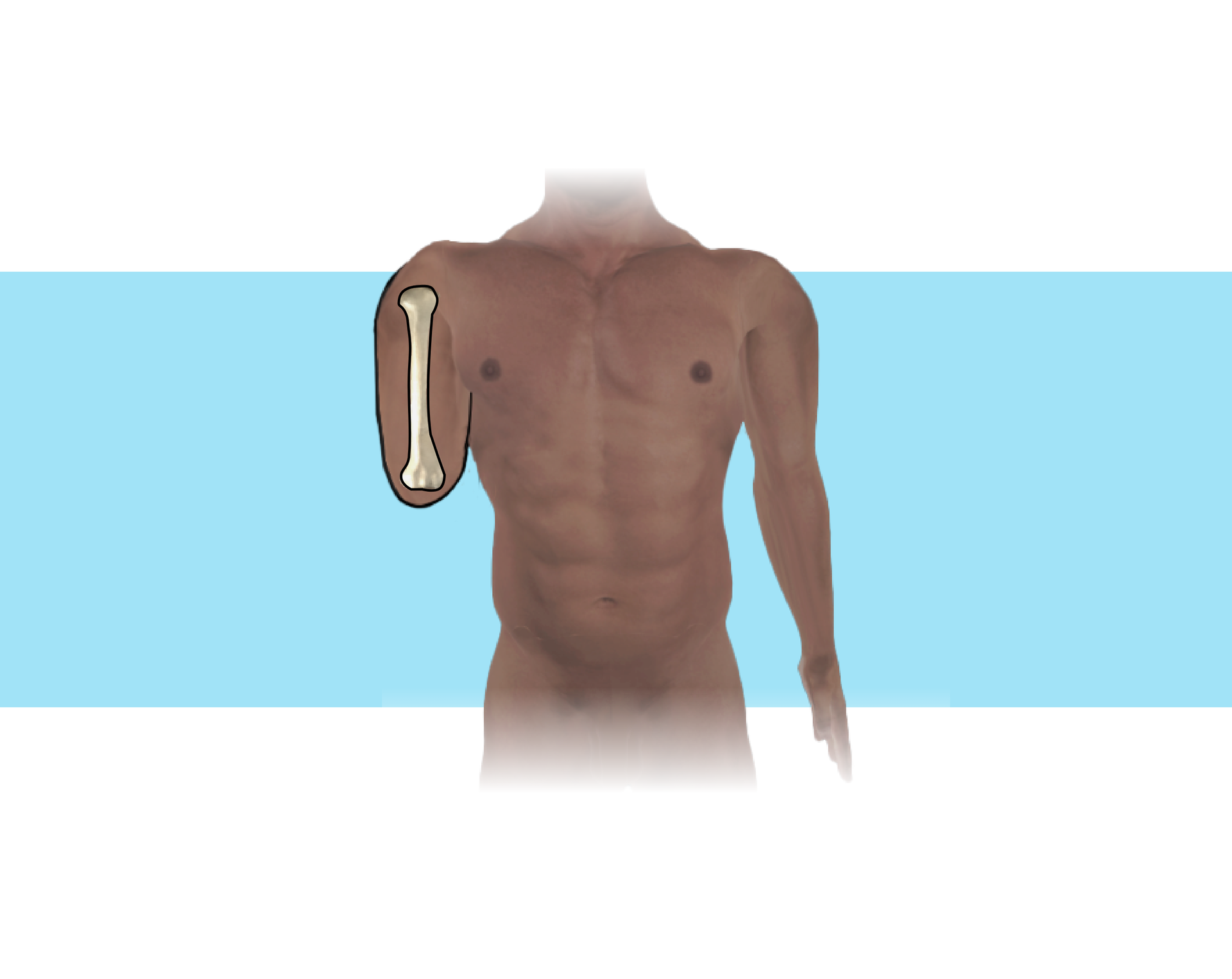 Grafika przedstawia ciało człowieka z bardzo krótkim kikutem ramienia. Na rycinie zaprezentowano kość w całości. Nienaruszona kość ramienna świadczy o tym, że amputację przeprowadzono w miejscu stawu łokciowego.