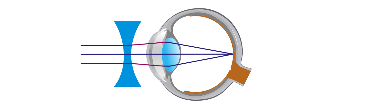 Na ilustracji zostało schematycznie pokazane oko jako kula. Przed okiem widzimy soczewkę rozpraszającą. Przed soczewką widzimy równoległe do siebie promienie światła w postaci odcinków. W momencie przejścia przez soczewkę ulegają one rozproszeniu i trafiają na soczewkę oka ulegając załamaniu i przecinają się w jednym punkcie znajdującym się na siatkówce oka. W ten sposób korygujemy wadę, którą nazywamy krótkowzrocznością.
