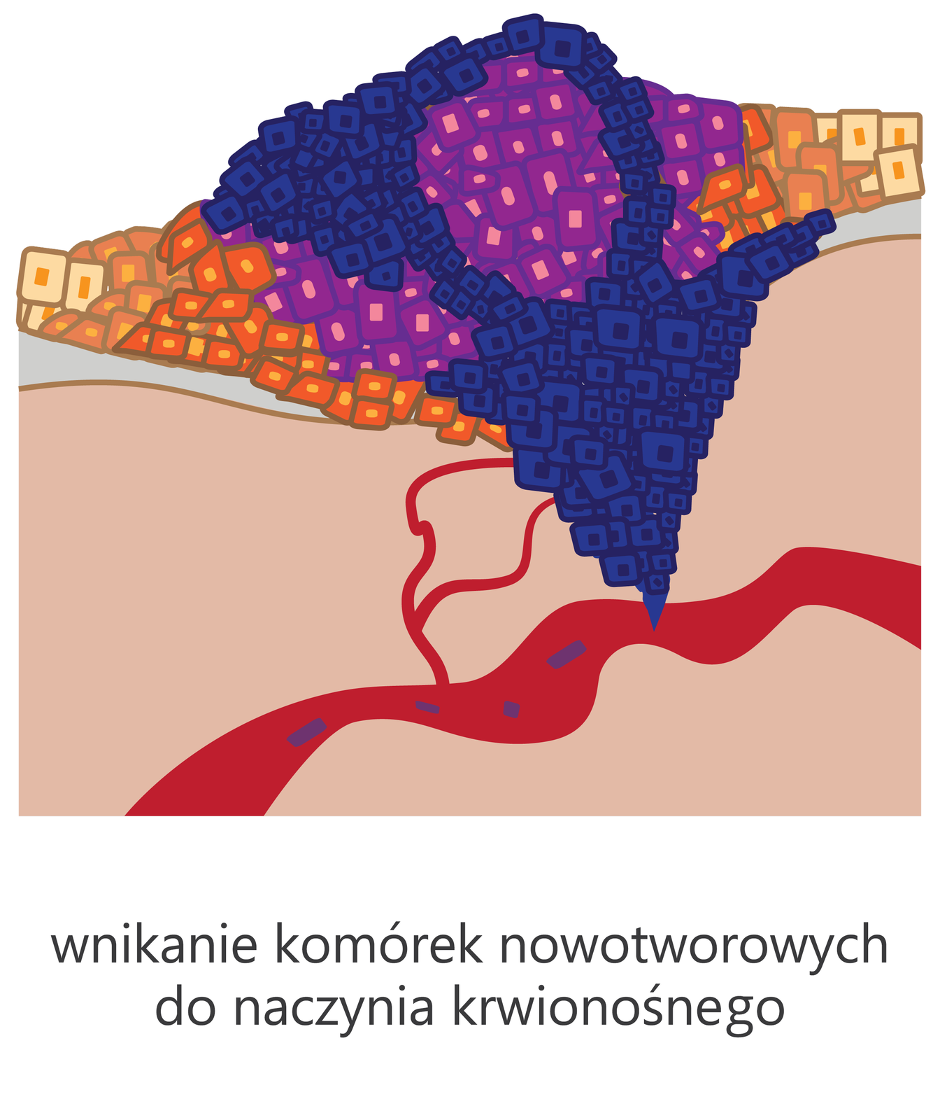 Ilustracja przedstawia guz rosnący w głąb tkanki, do naczynia krwionośnego. Widoczne są liczne komórki nowotworowe tworzące kilka warstw. Mają one cztery kolory, blado brązowy kolor oznacza najstarsze komórki nowotworowe, pomarańczowy młodsze, fioletowy jeszcze młodsze, a niebieski najmłodsze i najbardziej zjadliwe. Guz nacieka na tkanki znajdujące się poniżej. Naciekają komórki niebieskie. W głębi niższych warstw tkanek widać czerwone naczynie krwionośne. Komórki niebieskie sięgają do naczynia krwionośnego, odrywają się od guza pierwotnego i z krwią zaczynają krążyć po organizmie. Od guza do naczynia krwionośnego prowadzą również małe naczynia włosowate, które doprowadzają krew do guza. Pod obrazkiem widać napis: wnikanie komórek nowotworowych do naczynia krwionośnego.