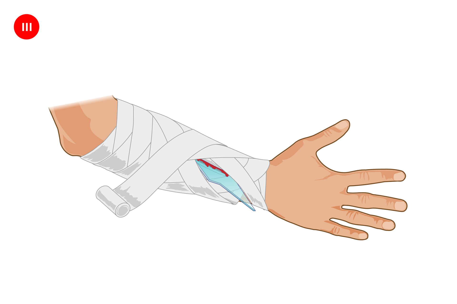 Ilustracja prezentująca sposób opatrywania rany z ciałem obcym. Prawa ręka skierowana zewnętrzną stroną do obserwatora, z wyprostowanymi palcami po prawej stronie. Powyżej nadgarstka podłużne miejsce zranienia z wbitym kawałkiem szkła tkwiącym pionowo w ranie. Na trzecim obrazku rana jest zabandażowana wraz z całym przedramieniem. Bandaż nawinięty w stylu na kłos.