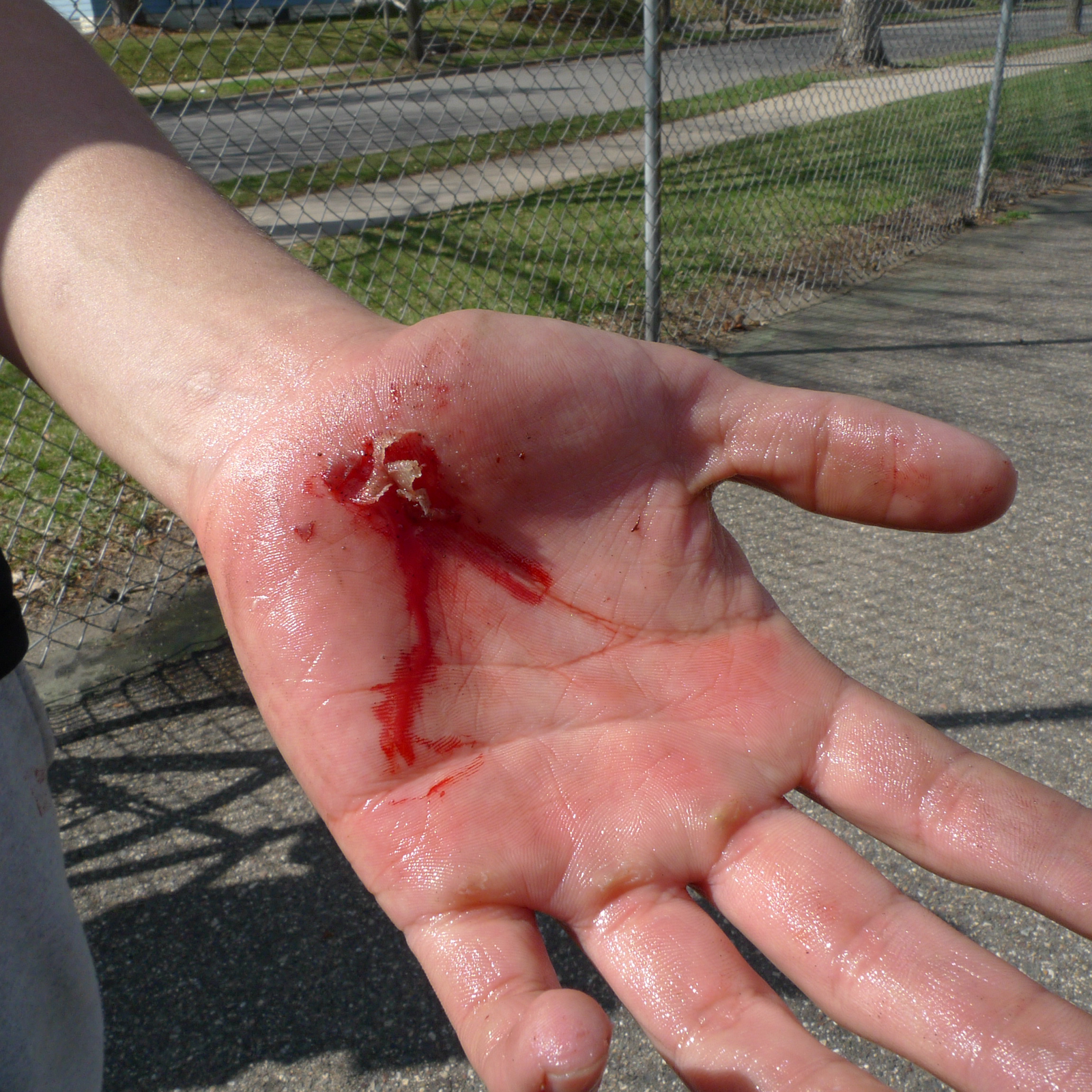 Galeria siedmiu zdjęć prezentujących różne rodzaje ran. Zdjęcie numer trzy przedstawia ranę szarpaną. Zbliżenie na otwartą lewą dłoń. Zranienie znajduje się blisko nadgarstka, poniżej kciuka na samym środku dolnej części dłoni. Z rany wypływa krew, widoczne kawałki zwisającej skóry.