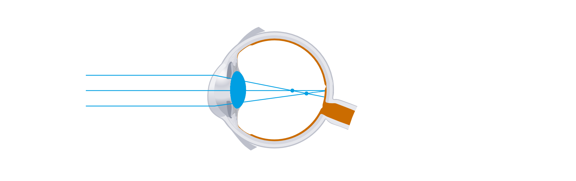 Na ilustracji przedstawiony został bieg promieni w oku astygmatyka bez korekcji. Równoległe promienie świetlne wpadają do oka ulegając załamaniu w wyniku którego przecinają się w dwóch różnych punktach.