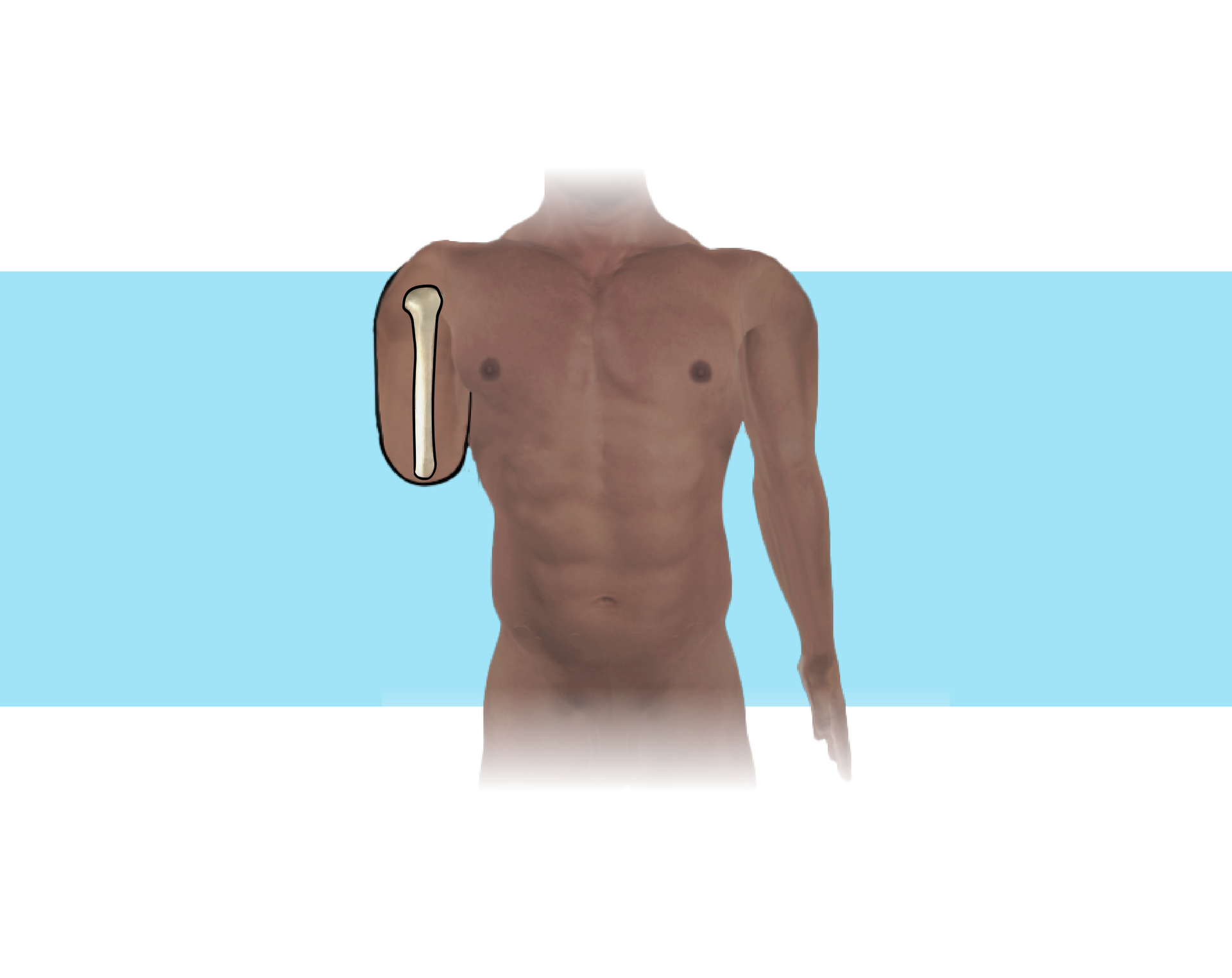 Grafika przedstawia ciało człowieka ze standardowym kikutem ramienia. Na rycinie zaprezentowano kość ramienną po amputacji w połowie długości.