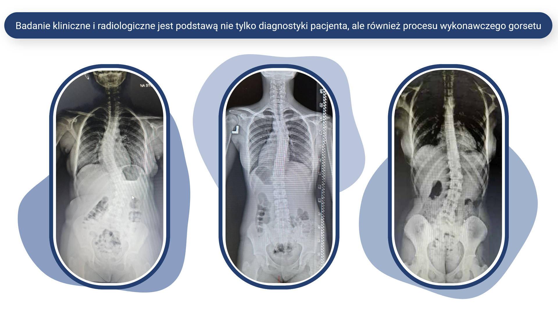 Plansza pod tytułem: Badanie kliniczne i radiologiczne jest podstawą nie tylko diagnostyki pacjenta, ale również procesu wykonawczego gorsetu. Plansza zawiera trzy zdjęcia rentgenowskie kręgosłupa. Na pierwszym zdjęciu kręgosłup jest wygięty w lewą stronę w odcinku piersiowym i w prawą stronę w odcinku lędźwiowym. Na drugim zdjęciu kręgosłup jest wygięty w prawą stronę w odcinku piersiowym. Na trzecim zdjęciu kręgosłup jest wygięty w prawą stronę w odcinku lędźwiowym.