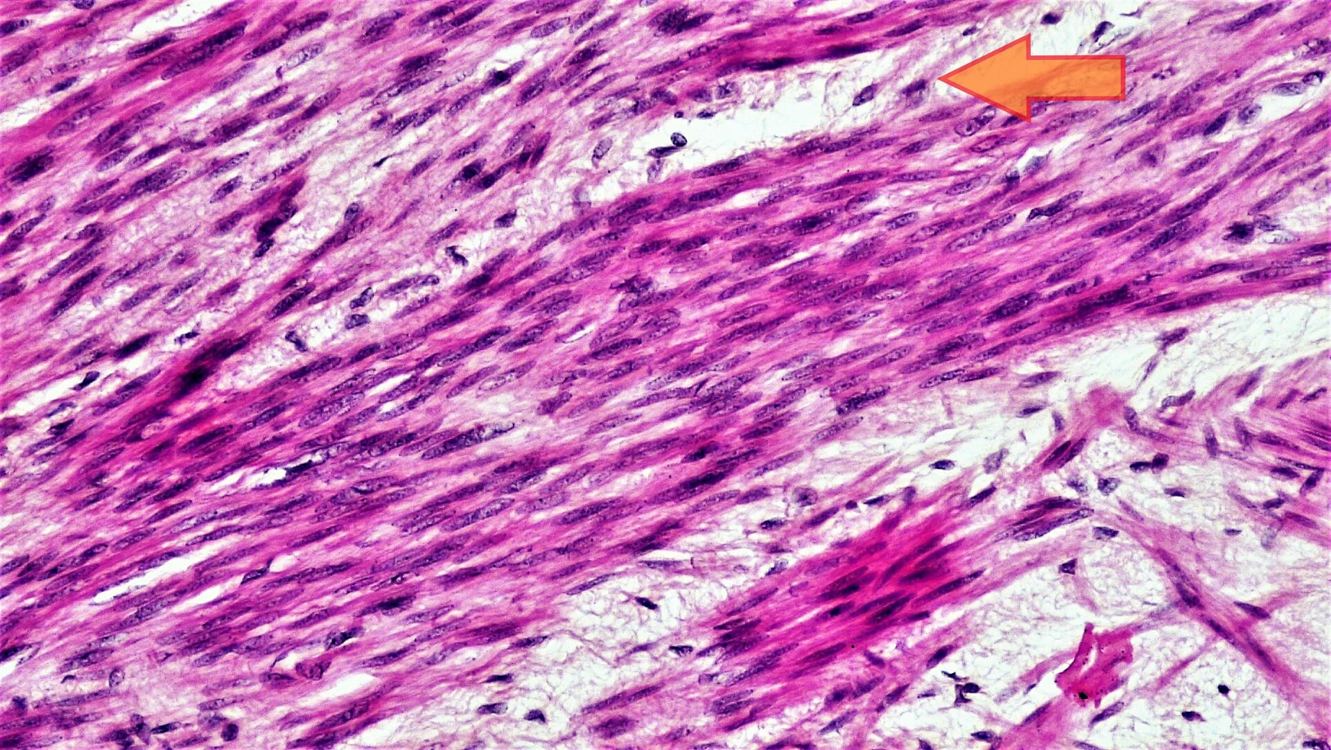  Zdjęcie przedstawia tkankę mięśniową gładką. Ma ona fioletowe zabarwienie i jej struktura rozciąga się poziomo przez całą długość zdjęcia. Pomiędzy tymi strukturami znajdują się zabarwione na biało nieciągłości. W tkance znajdują się jądra komórkowe. Mają one ciemnofioletowy, eliptyczny kształt. Na zdjęciu jedno z jąder wskazuje pomarańczowa strzałka. 