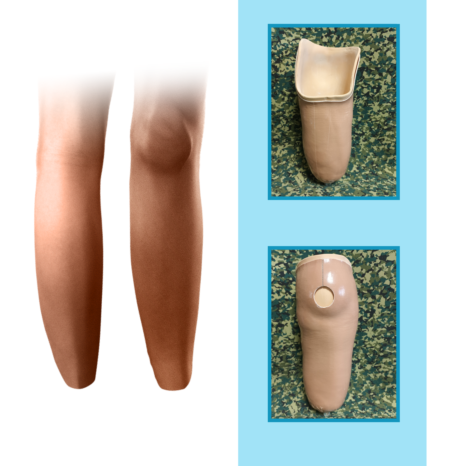 Grafika przedstawia długi kikut podudzia w widoku z przodu i z tyłu. Na rycinie zamieszczono również zdjęcia leja typu KBM w widoku z przodu i z tyłu. Lej został wykonany z tworzywa sztucznego. W przedniej części, w okolicy rzepki ma on wycięcie.