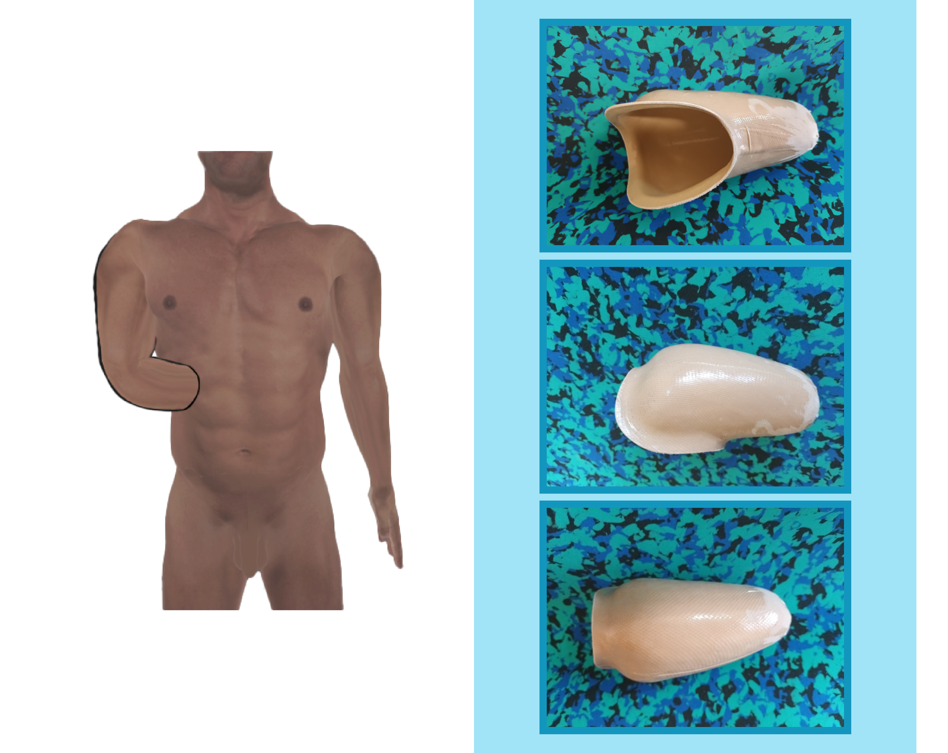 Grafika przedstawia człowieka z krótkim kikutem przedramienia. Na rycinie zamieszczono również trzy zdjęcia leja w widoku z dołu, góry i boku. Dopasowany do kikuta lej jest wykonany z tworzywa sztucznego.