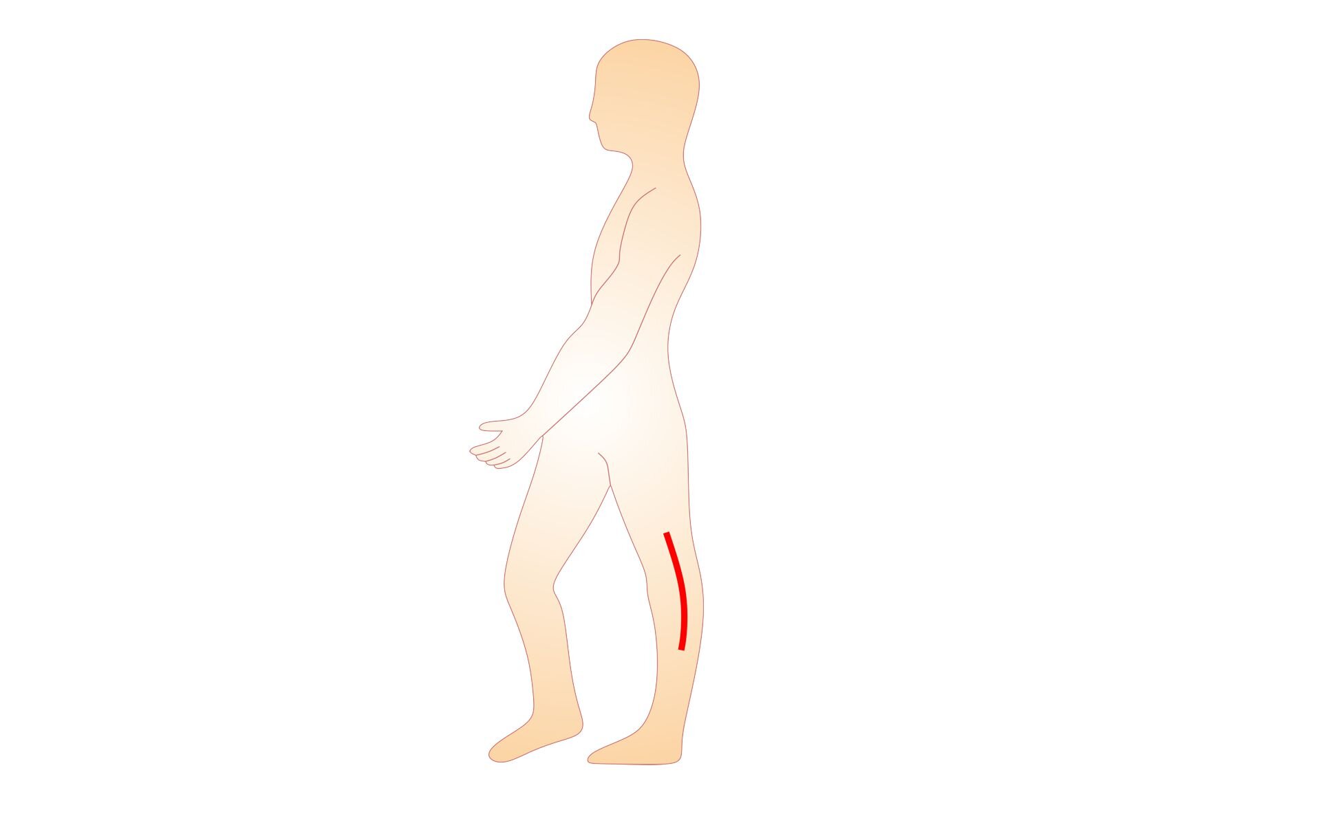 Grafika przedstawia sylwetkę człowieka z zaznaczonym obszarem stawu kolanowego wygiętego ku tyłowi. 