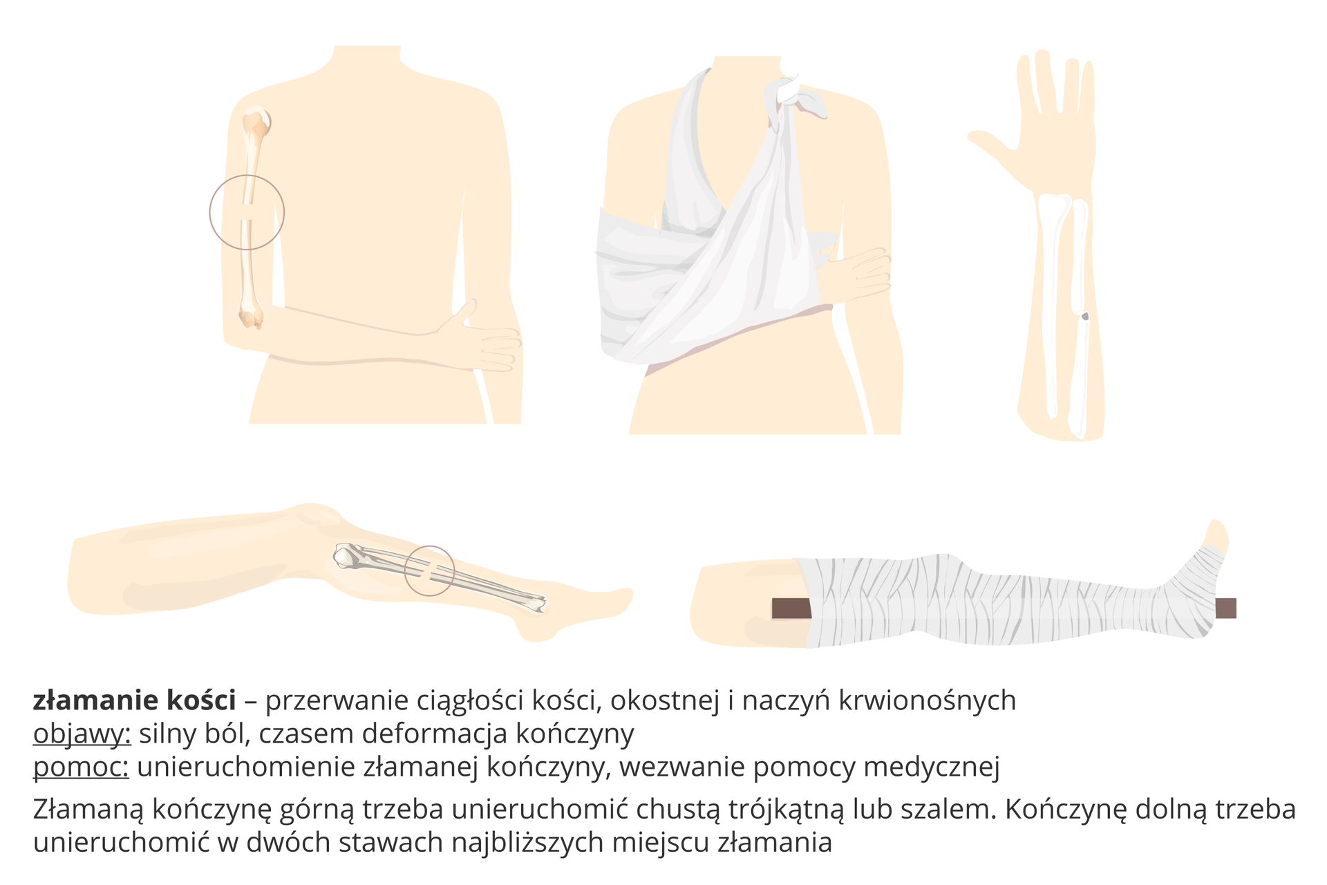 Ilustracja przedstawia różowe torsy i kończyny z wrysowanymi kośćmi, które uległy złamaniu. Z lewej u góry: przerwanie ciągłości kości ramiennej. Pierwsza pomoc: unieruchomienie ręki za pomocą dwóch chust lub bandaży. Z prawej złamanie kości łokciowej. Taka sama pierwsza pomoc. U dołu: złamanie obu kości podudzia. Pierwsza pomoc: usztywnienie sąsiednich stawów i zawinięcie kończyny. Objawy złamania: silny ból, czasem deformacja kończyny. Pomoc: unieruchomienie kończyny, wezwanie pomocy medycznej.