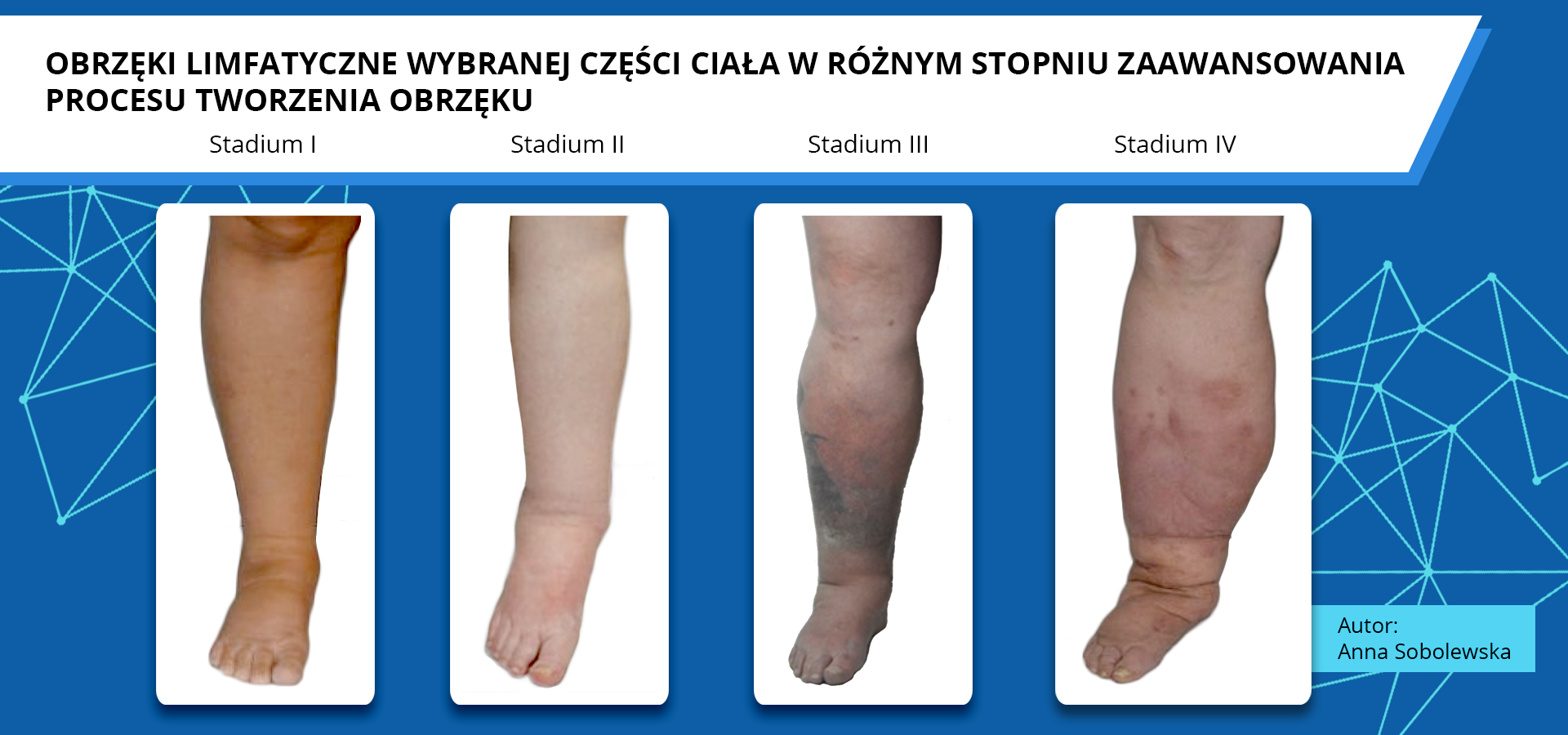 Zdjęcia pod tytułem obrzęki limfatyczne wybranej części ciała w różnym stopniu zaawansowania procesu tworzenia obrzęku. Na czterech zdjęciach znajdują się cztery stadia opuchlizny, od nieznacznie powiększonej kończyny dolnej, do kończyny dolnej znacznie powiększonej na całej długości, z przebarwieniami i wybroczynami. Autorka zdjęć: Anna Sobolewska.