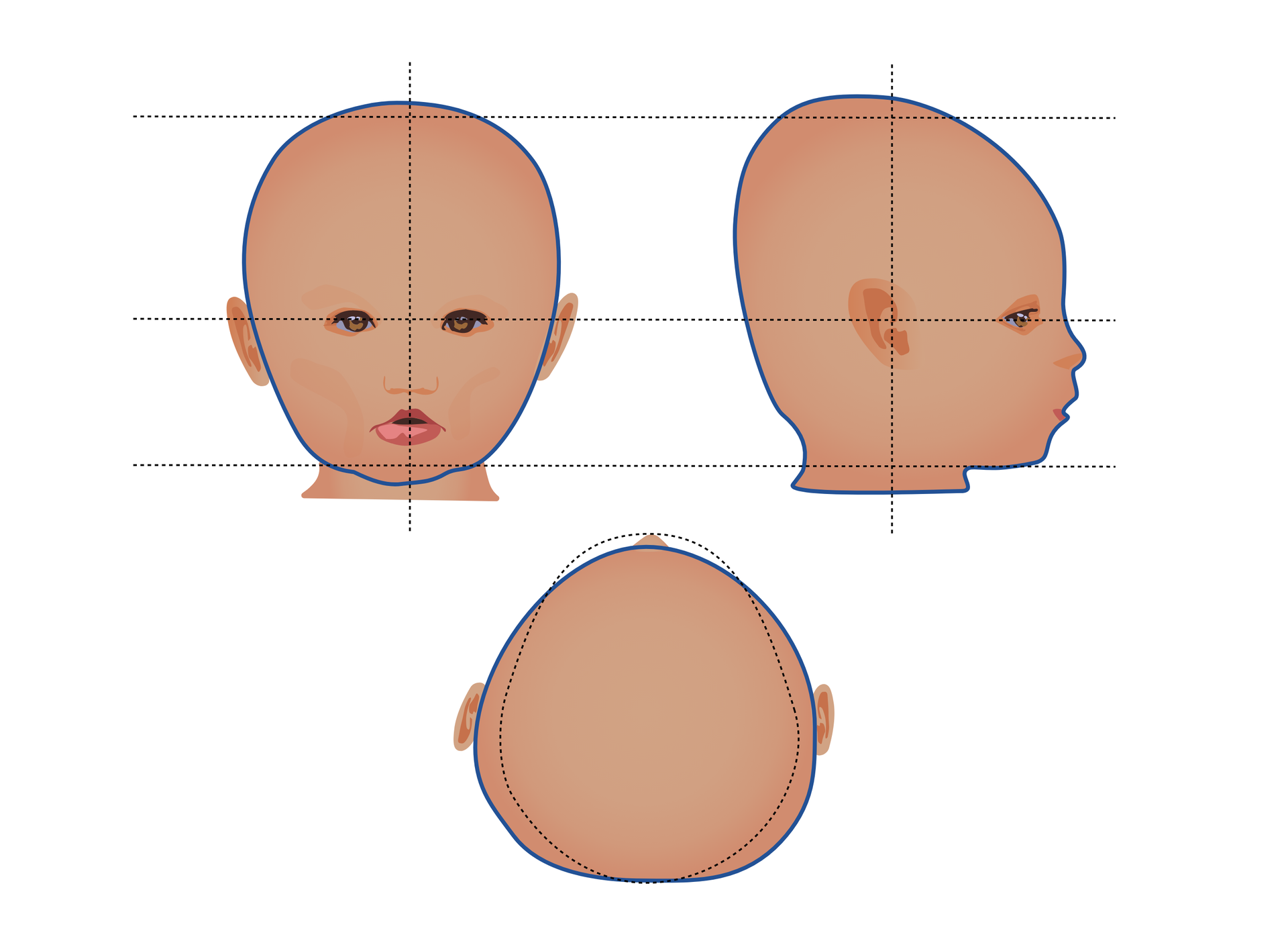 Schemat głowy dziecka z brachycefalią symetryczną przedstawiony z przodu, góry i boku. Głowa jest spłaszczona bocznie, co najlepiej uwidacznia rzut z góry.

