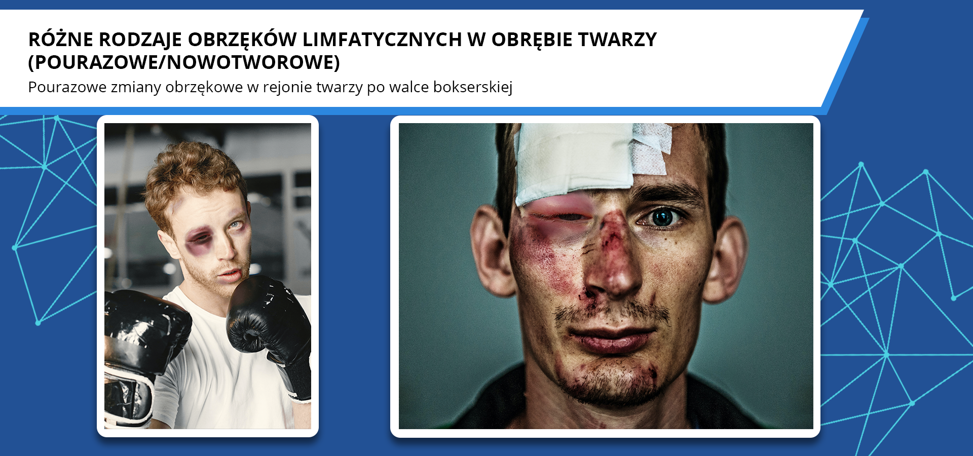Zdjęcia o tytule różne rodzaje obrzęków limfatycznych w obrębie twarzy, pourazowe lub nowotworowe. Pourazowe zmiany obrzękowe w rejonie twarzy po walce bokserskiej. Pierwsze zdjęcie przedstawia mężczyznę z podbitym okiem i uniesionymi rękami w rękawicach bokserskich. Drugie zdjęcie przedstawia twarz mężczyzny z opuchniętym okiem, przekrzywionym i poranionym nosem oraz opatrunkiem na czole. 