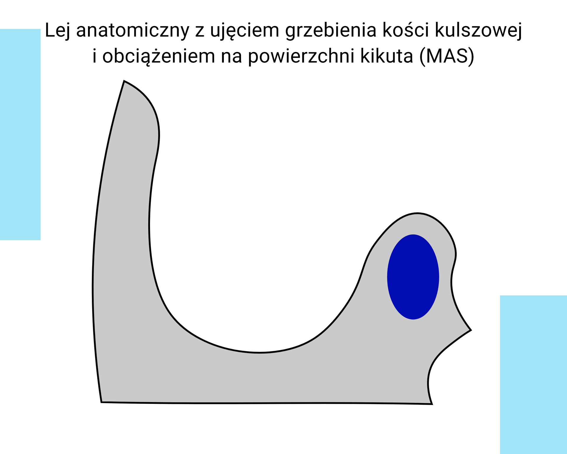 Schemat graficzny przedstawiający przekrój czołowy leja anatomicznego z ujęciem grzebienia kości kulszowej i obciążeniem na powierzchni kikuta (MAS).