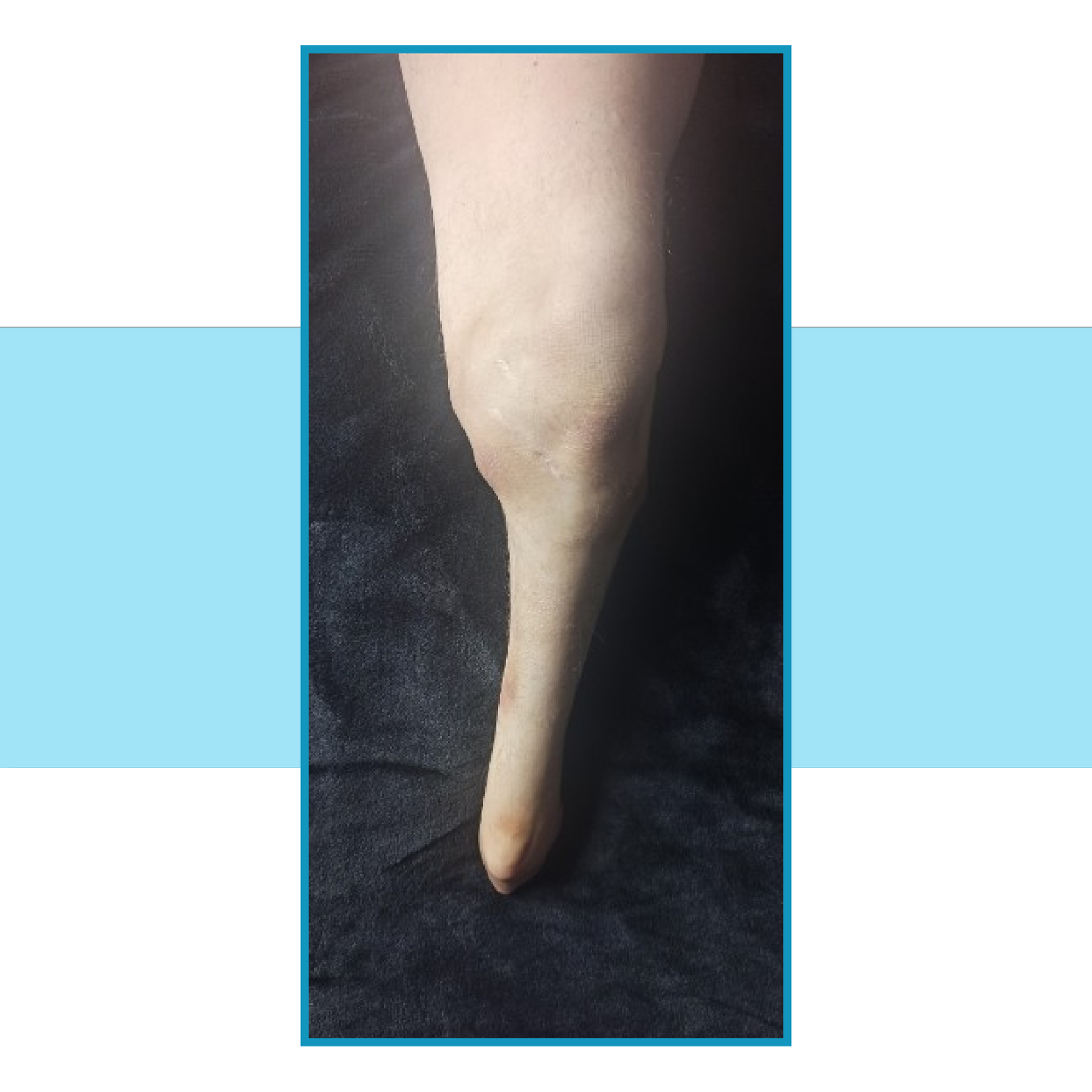 Zdjęcie długiego kikuta kończyny dolnej po amputacji w rejonie podudzia.