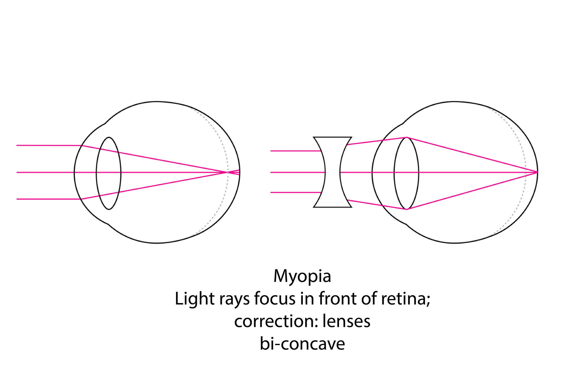 W galerii są rysunki, ilustrujące wady wzroku i sposoby ich korekcji. Oko z lewej jest krótkowzroczne. Promienie świetlne skupiają się przed siatkówką. Wada korygowana soczewkami dwuwklęsłymi, zmieniającymi kąt załamania promieni.