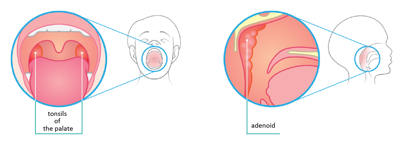 Ilustracja przedstawia dwa kolorowe rysunki gardła człowieka: wprost i profilem. Obok powiększeń schematyczne rysunki głowy człowieka z szeroko otwartymi ustami. Z lewej w głębi za różowym językiem wskazano pomarańczowe migdałki podniebienne po obu stronach gardła. Z prawej na powiększeniu wskazano groniasty migdałek gardłowy na tylnej ścianie gardła. Podpisano: tonsils of the palate; 
adenoid