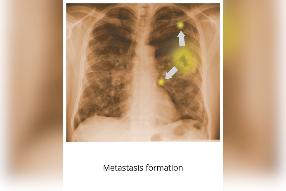 Ilustracja przedstawia rentgenogram płuc, widać duży guz w lewym płucu i kilka małych. Podpisano: Metastasis formation