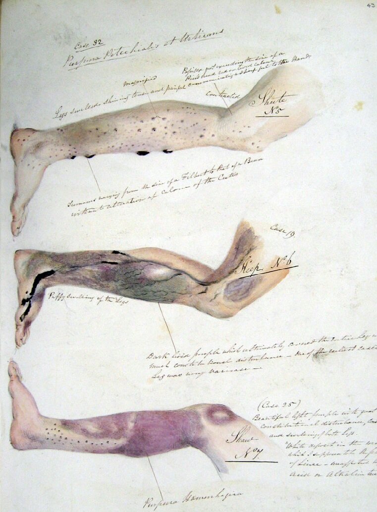 Rysunek przedstawia trzy narysowane nogi. Pierwsza posiada liczne czarne krosty, druga mocno widoczne żyły i zaczerwienienia, a trzecia duże siniaki i małe czarne krosty. Obok każdej nogi znajdują się liczne strzałki i podpisy. 