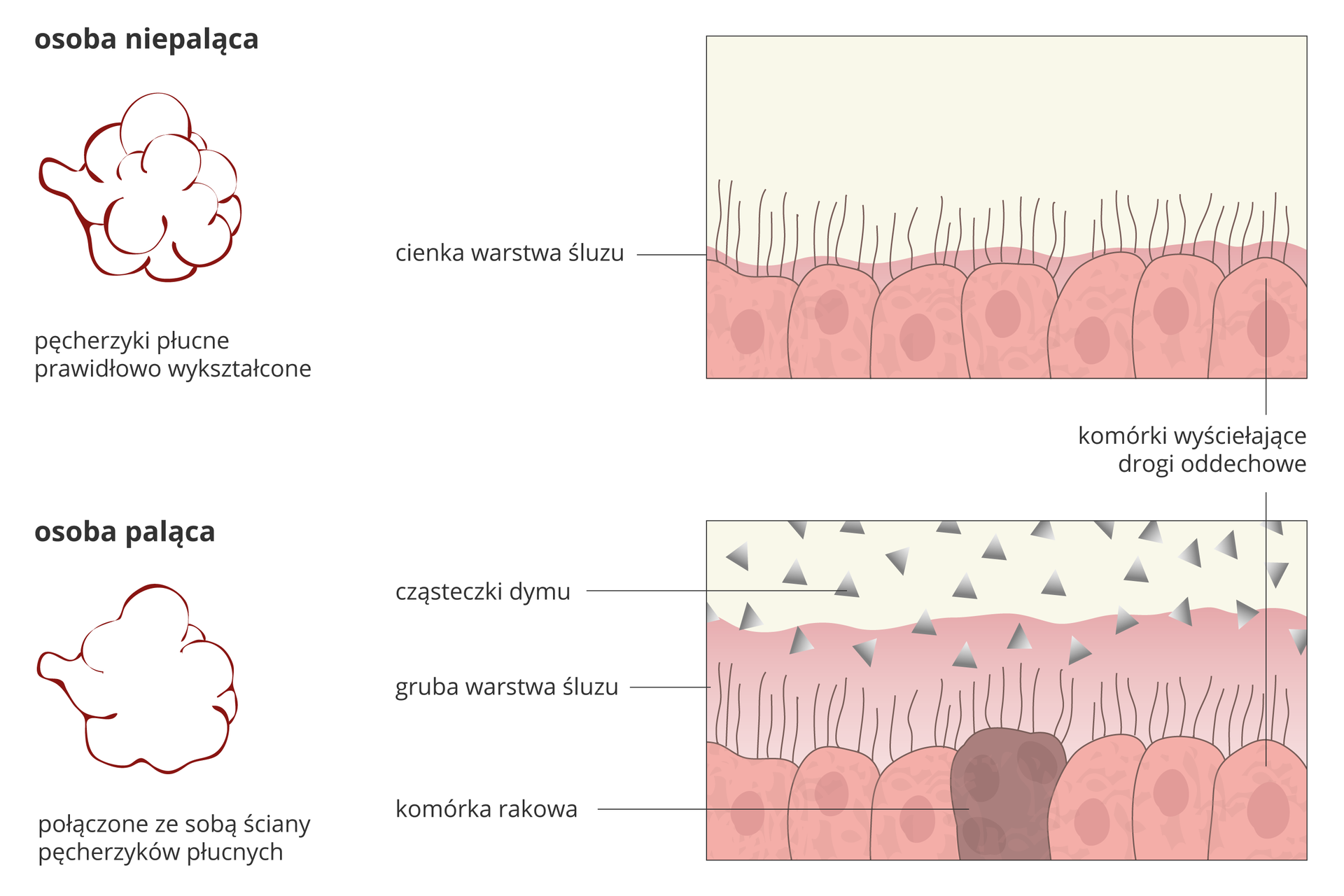 Ilustracja przedstawia schematycznie 4 rysunki, porównujące budowę dróg oddechowych u osoby niepalącej (górny rząd) i u palącej. Z lewej znajdują się pęcherzyki płucne. Z prawej powiększenie nabłonka dróg oddechowych. U osoby niepalącej pęcherzyki płucne są prawidłowo wykształcone. U palacza (na dole) ich ściany łączą się ze sobą. U osoby niepalącej komórki wyścielające drogi oddechowe są prawidłowe, pokryte cienką warstwą śluzu. U palacza warstwa śluzu jest gruba i przykrywa rzęski. Między różowymi komórkami jest ciemna komórka rakowa. Cząsteczki dymu zilustrowano w postaci szarych trójkątów.