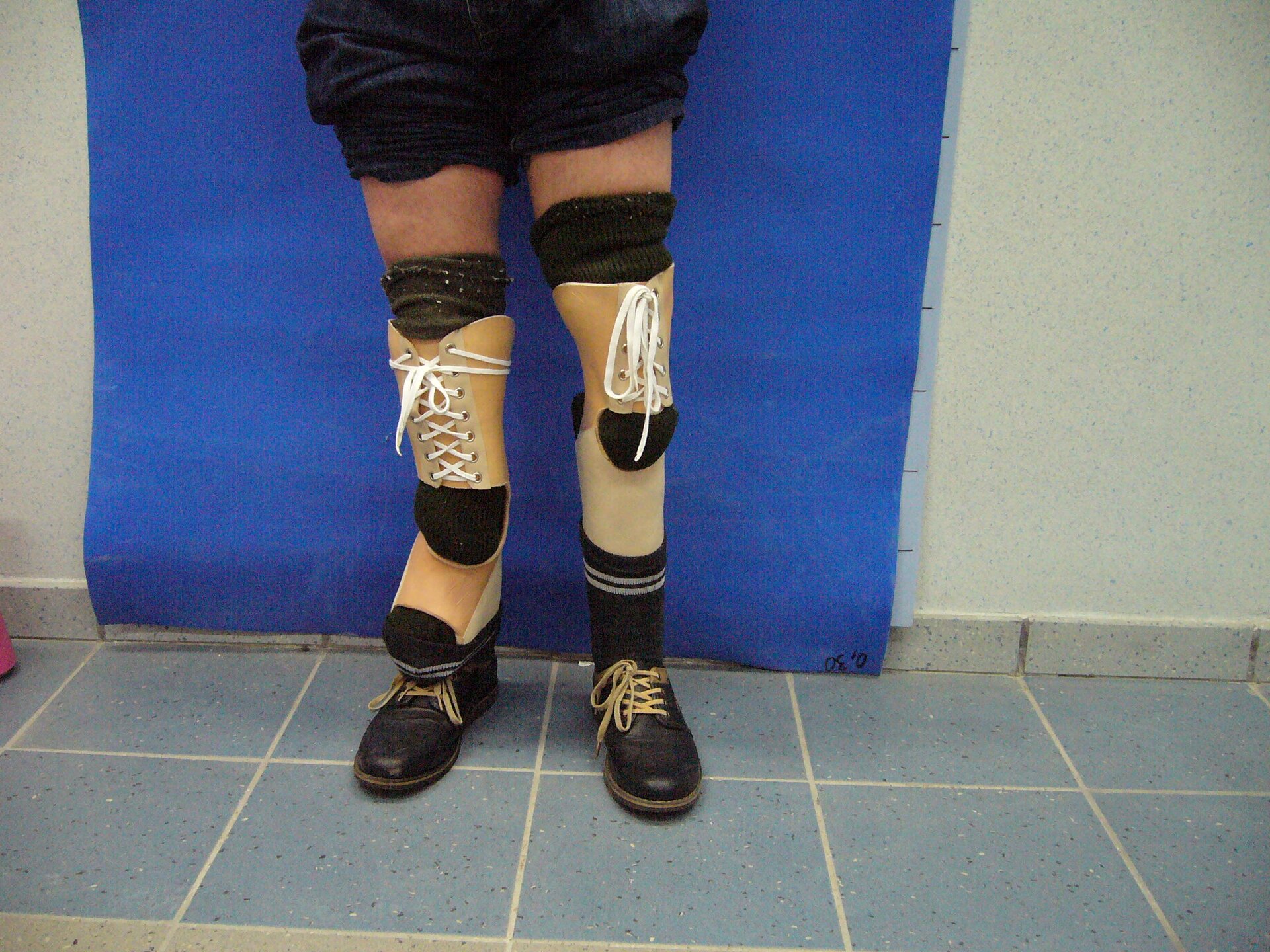 Zdjęcie pod tytułem: Wyrównanie protezowe. Zdjęcie przedstawia nogi pacjenta umieszczone w sznurowanych stabilizatorach i protezach wyrównujących długość kończyn.