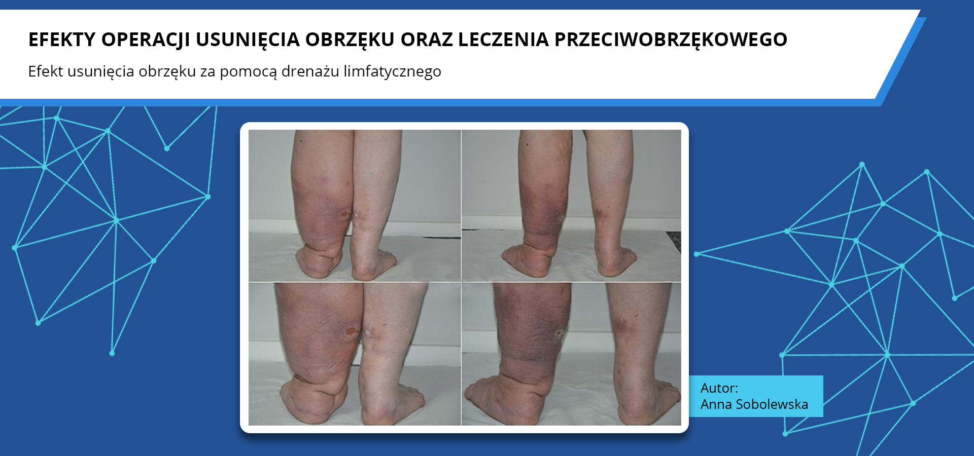 Zdjęcia pod tytułem efekty operacji usunięcia obrzęku oraz leczenia przeciwobrzękowego. Efekt usunięcia obrzęku za pomocą drenażu limfatycznego. Zdjęcia przedstawiają kończyny dolne przed i po drenażu limfatycznym. Przed zabiegiem jedna z kończyn jest znacząco opuchnięta i przebarwiona, z widocznymi ranami. Opuchlizna i przebarwienie są dużo łagodniejsze po zabiegu, a rany wydają się częściowo zagojone. Autorka zdjęć: Anna Sobolewska.