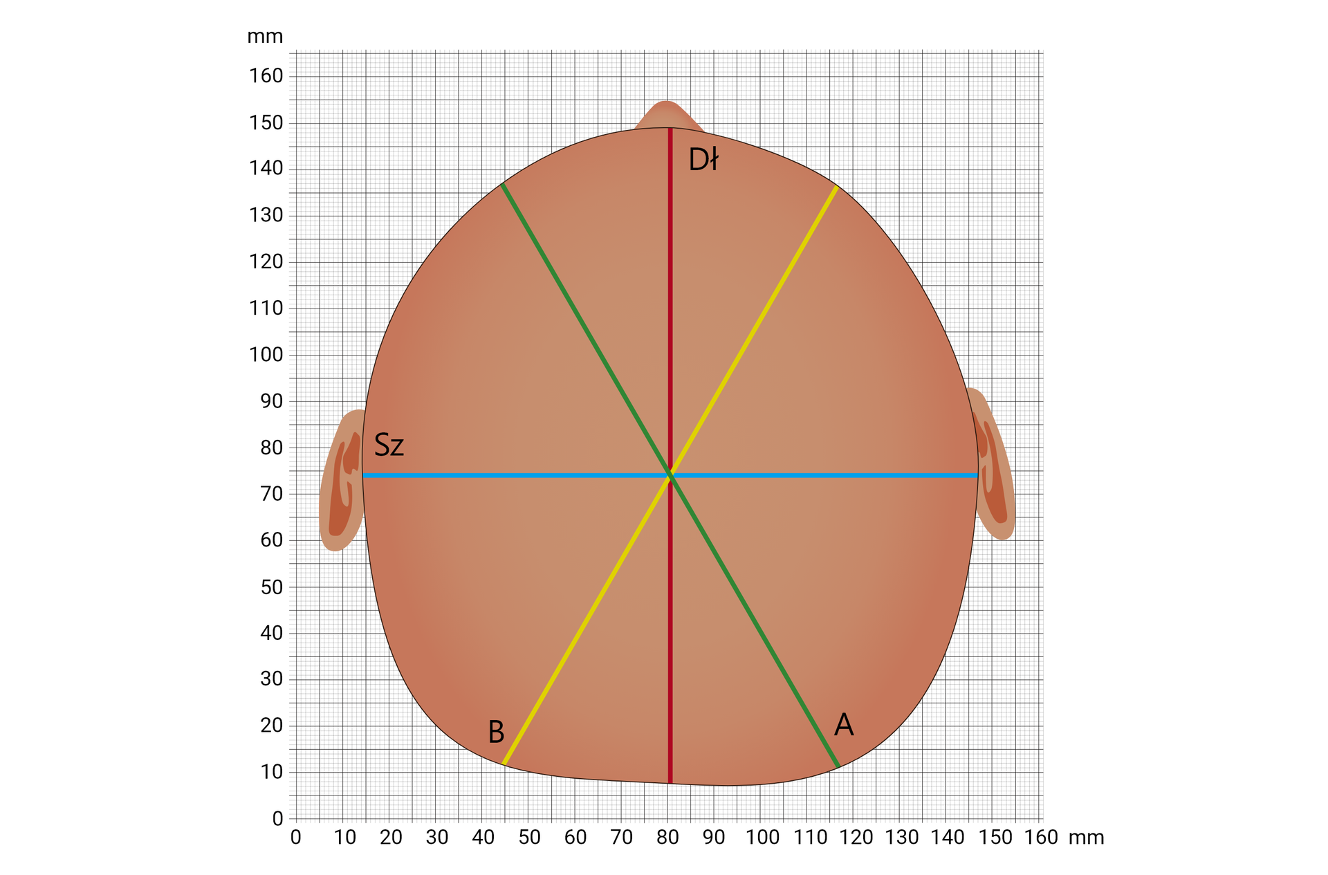 Grafika przedstawiająca przykładową czaszkę dziecka z brachycefalią symetryczną. Na zamieszczonym na siatce milimetrowej schemacie zaznaczono odległości: skośną krótszą, skośną dłuższą, szerokość i długość. 