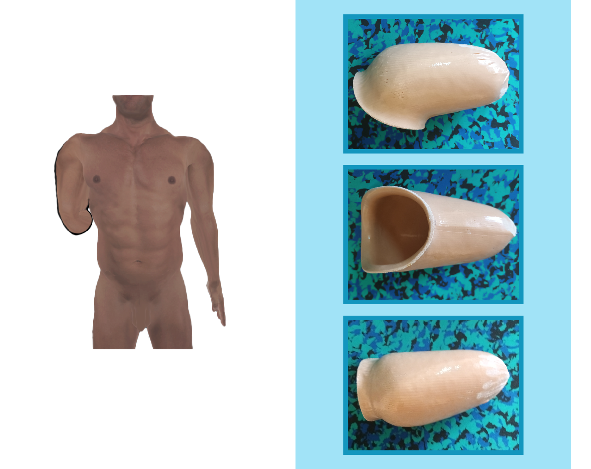 Grafika przedstawia człowieka z bardzo krótkim kikutem przedramienia. Na rycinie zamieszczono również trzy zdjęcia leja w widoku z dołu, góry i boku. Dopasowany do kikuta lej jest wykonany z tworzywa sztucznego.