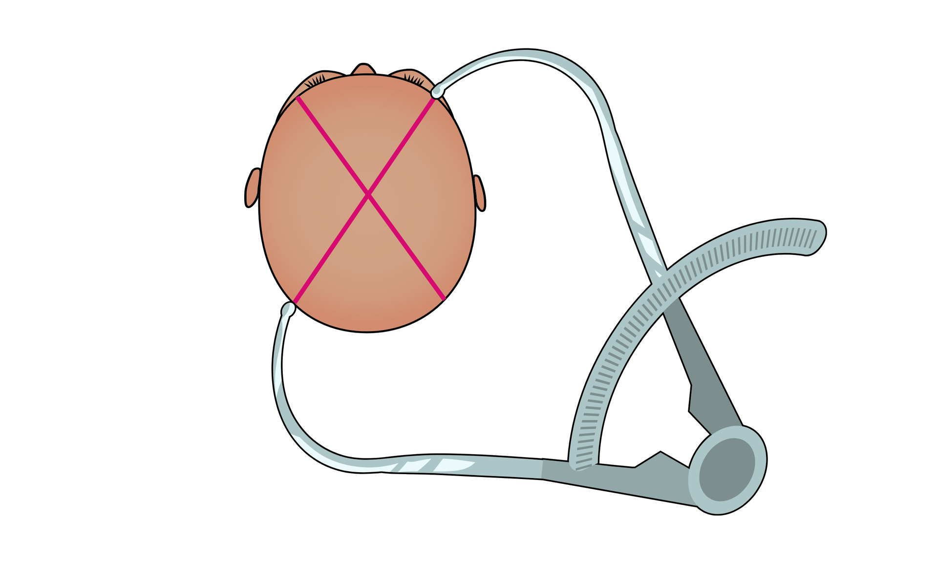 Aby dokonać pomiaru skośnego czaszki, cyrkiel kabłąkowy przykłada się do czaszki w taki sposób, że jedno ramię dotyka przestrzeni w okolicy skroni, a drugie przeciwnej strony czaszki. Wynik jest sczytywany z miarki. 