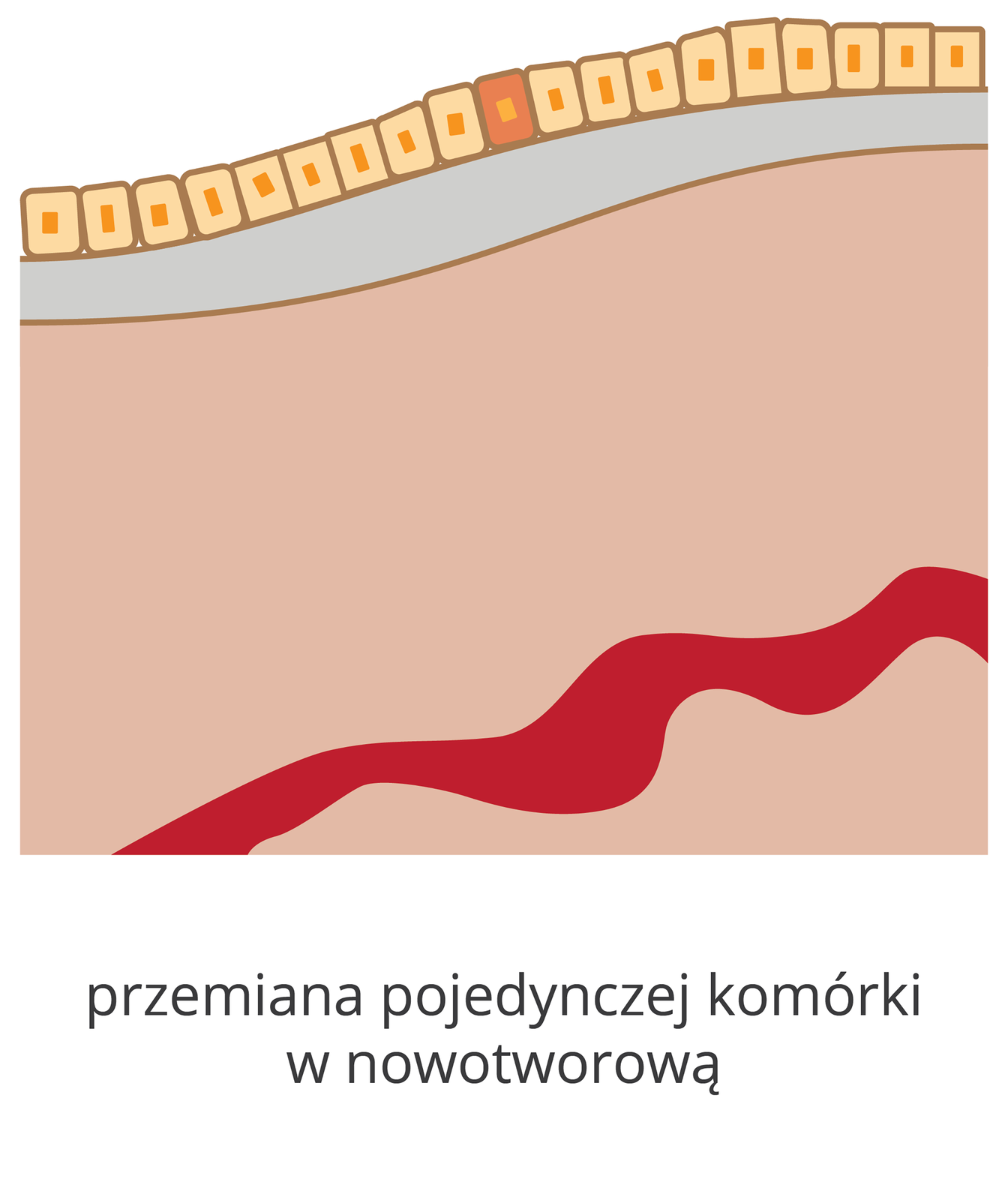 Schemat przedstawia pojedynczą komórkę, w której zaszła zmiana nowotworowa. Widoczna jest warstwa komórek nabłonka. Leżą one obok siebie, w przekroju mają kształt prostokąta. Wewnątrz widać koliste jądro. Pod spodem widać dwie warstwy innych komórek. Jest ona narysowana schematycznie, nie widać poszczególnych komórek. W głębi drugiej warstwy widać czerwone naczynie krwionośne. Jedna z komórek nabłonka ma zmieniony kolor. W niej zaszła zmiana nowotworowa. Pod obrazkiem widać napis: przemiana pojedynczej komórki w nowotworową.