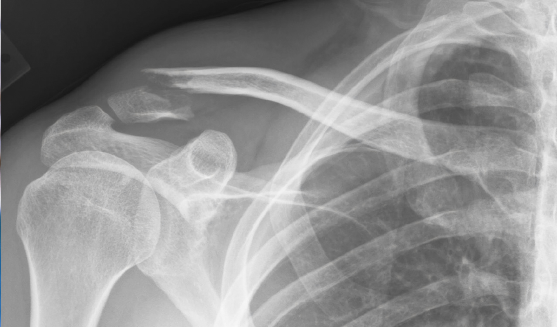 Fotografia przedstawia RTG złamanego obojczyka. Fotografia monochromatyczna. Prezentuje przerwaną fragment klatki piersiowej żebra oraz złamany obojczyk.