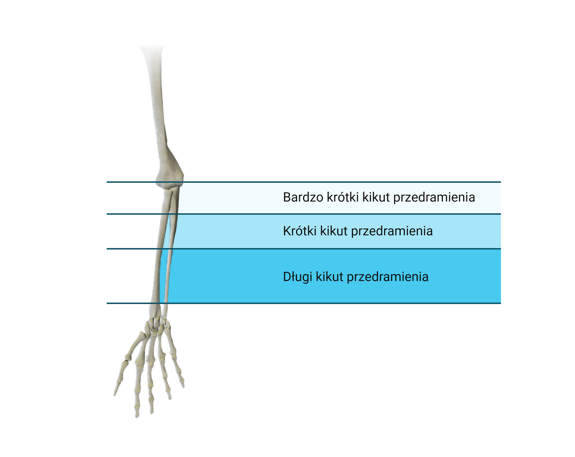 Grafika przedstawia szkielet kończyny górnej. Na rycinie zaznaczono rejony amputacji skutkującej powstaniem bardzo krótkiego, krótkiego i długiego kikuta przedramienia. Bardzo krótki kikut powstaje po amputacji w okolicy stawu łokciowego. Krótki kikut występuje po amputacji w jednej trzeciej długości przedramienia. Długi kikut powstaje po amputacji w dalszych dwóch trzecich długości przedramienia.